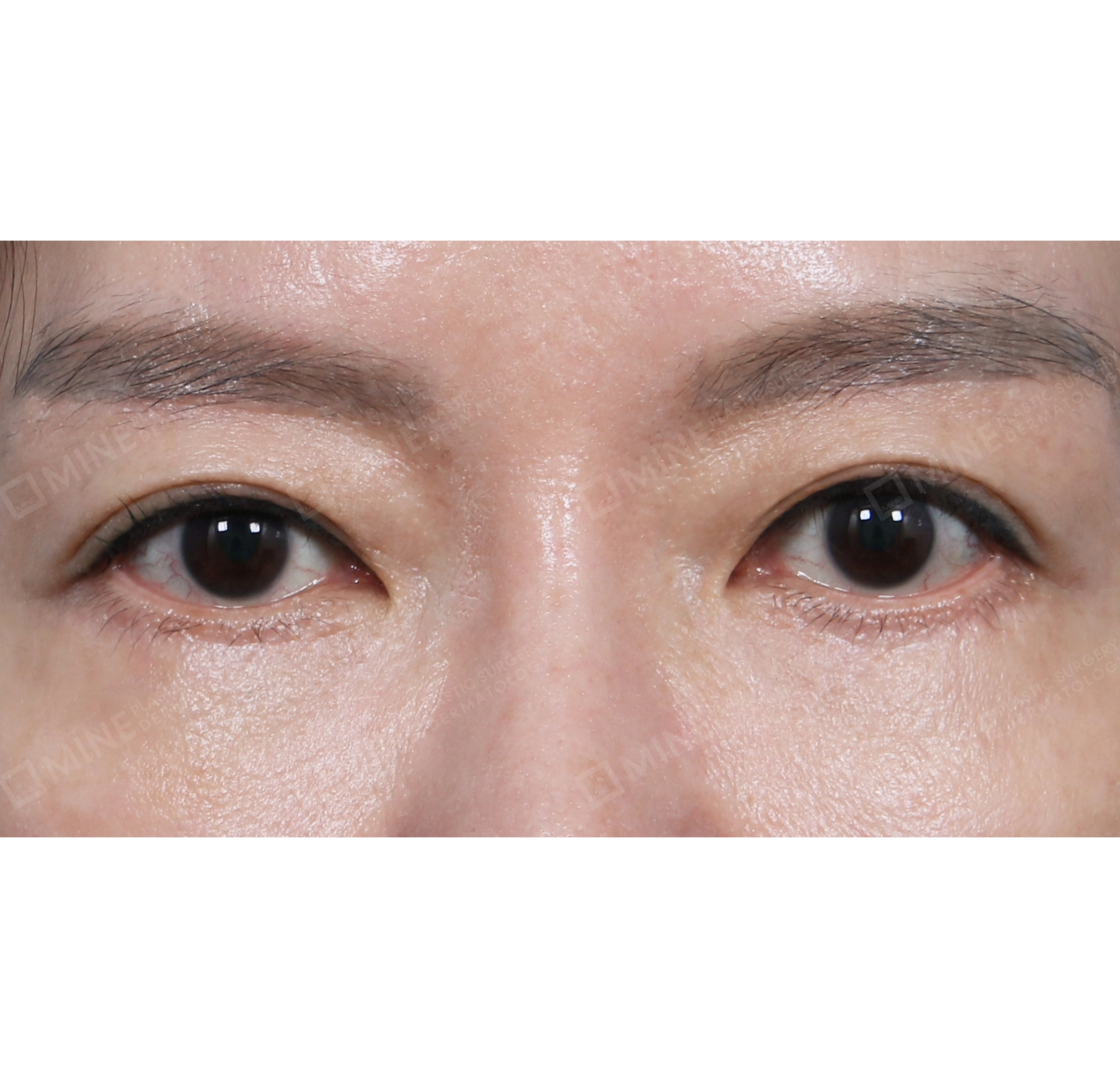 눈썹하거상 + 하안검재수술-전후-후