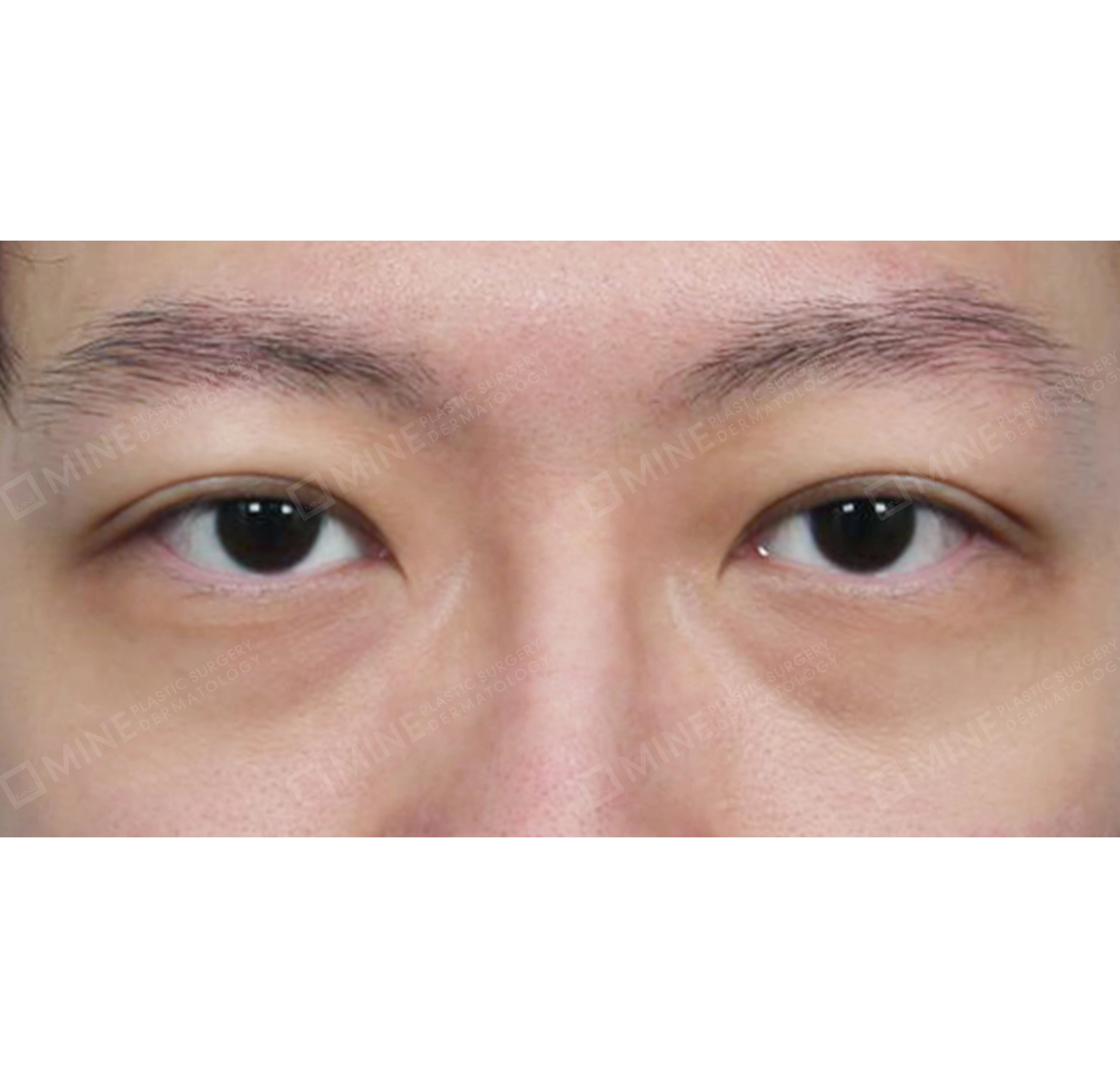 절개눈매교정-전후-후