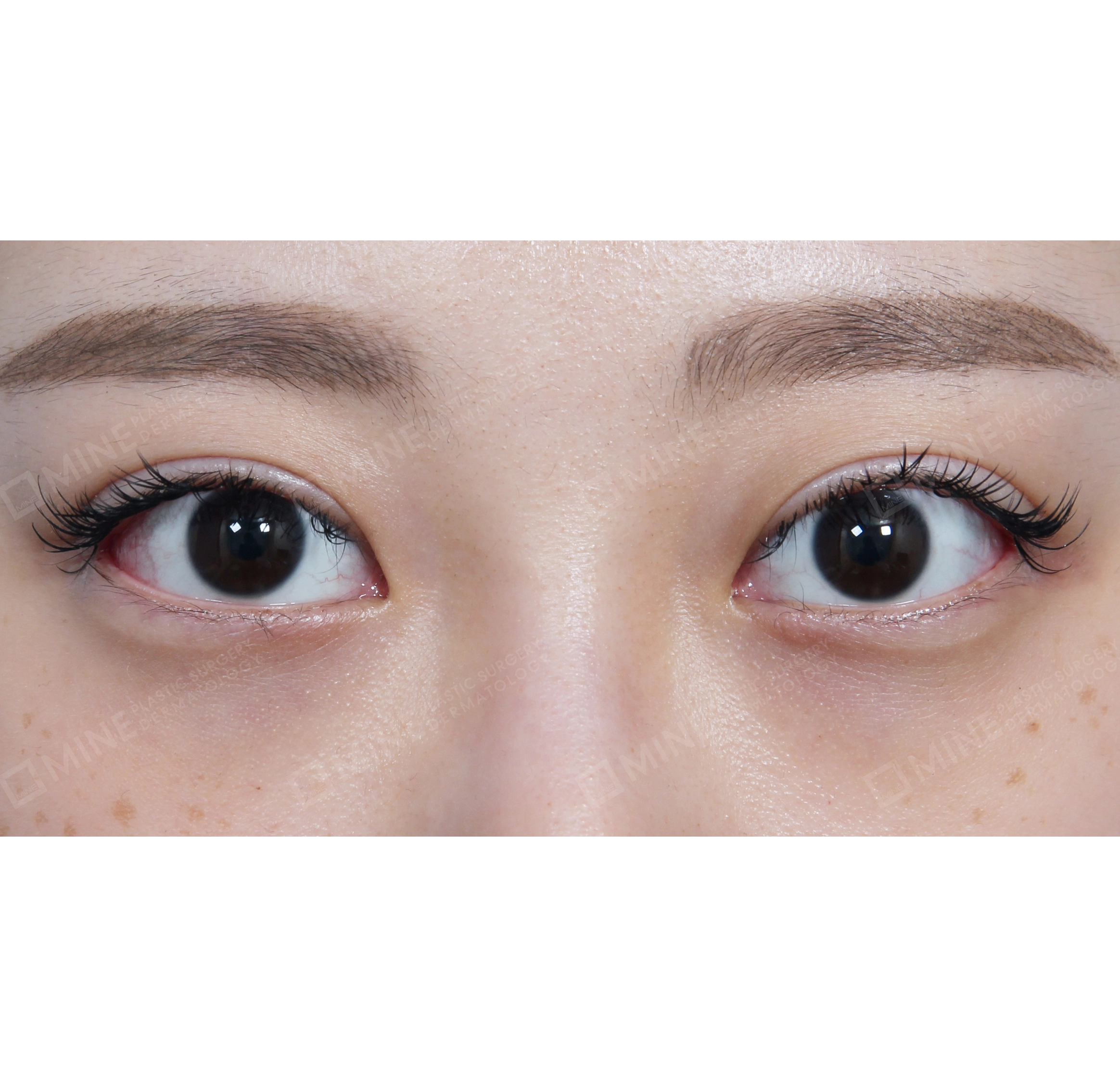 뒷트임-전후-후