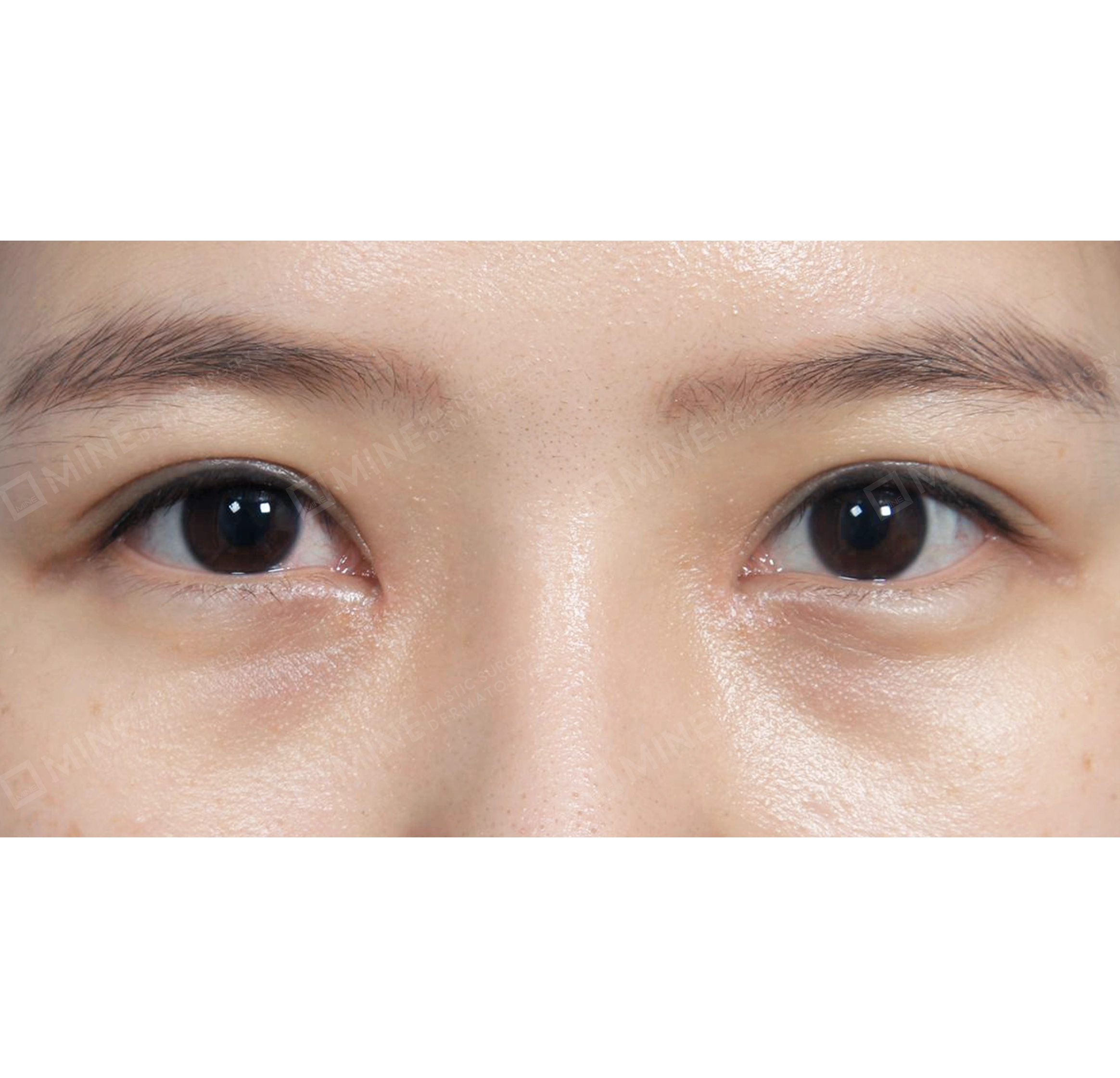 매몰 + 앞트임-전후-후