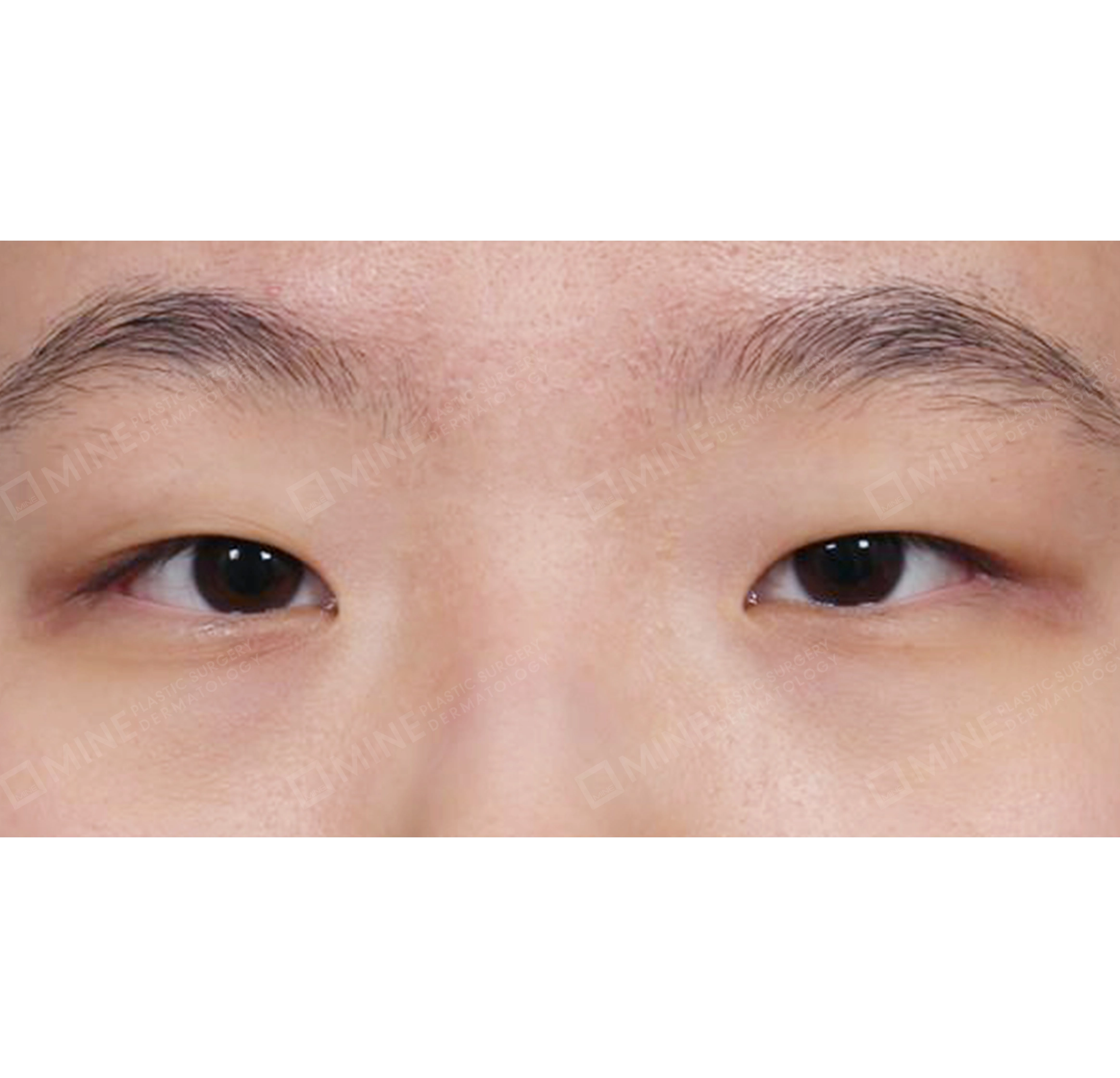 절개눈매교정 + 앞트임-전후-전