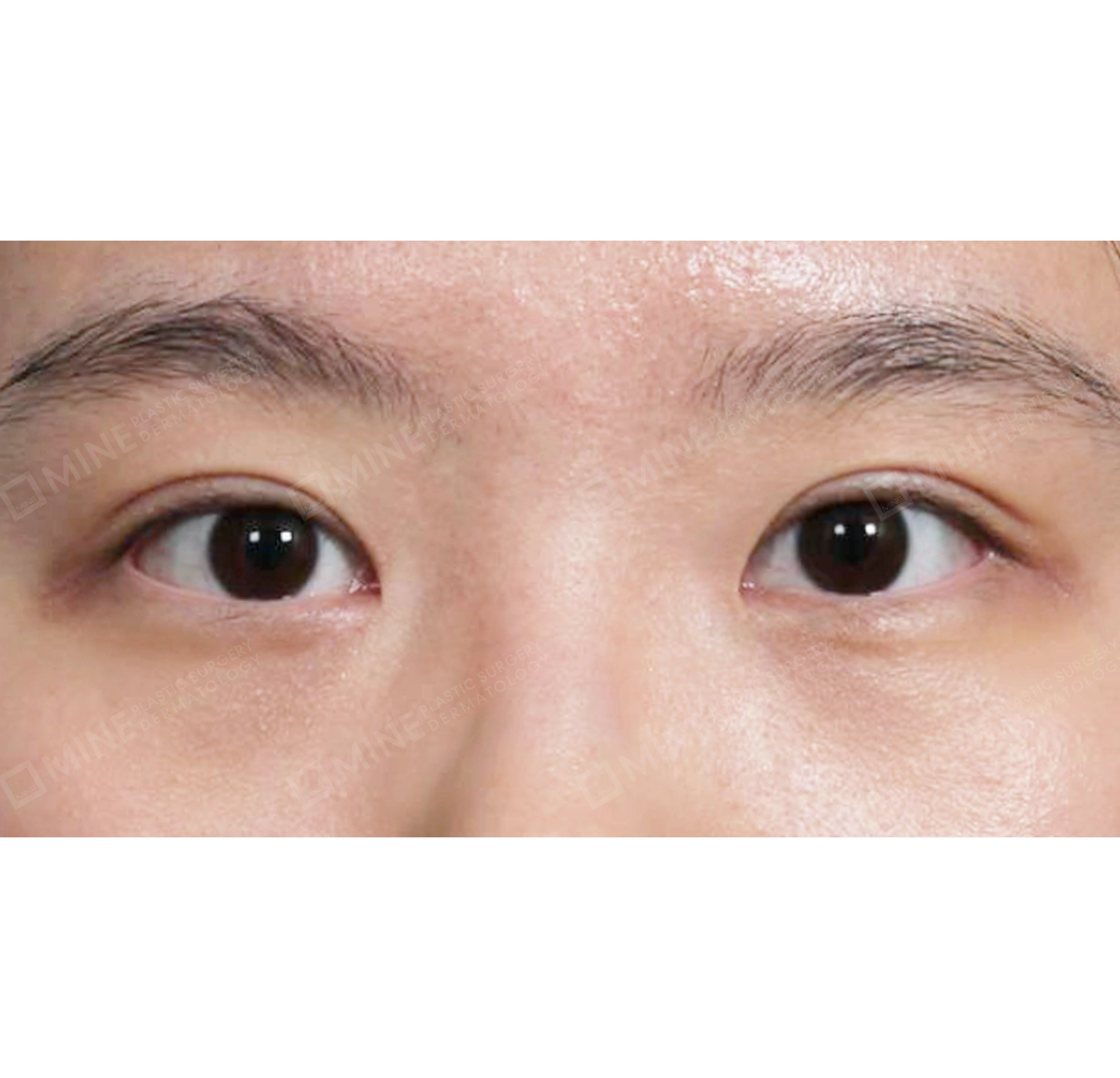절개눈매교정 + 앞트임-전후-후