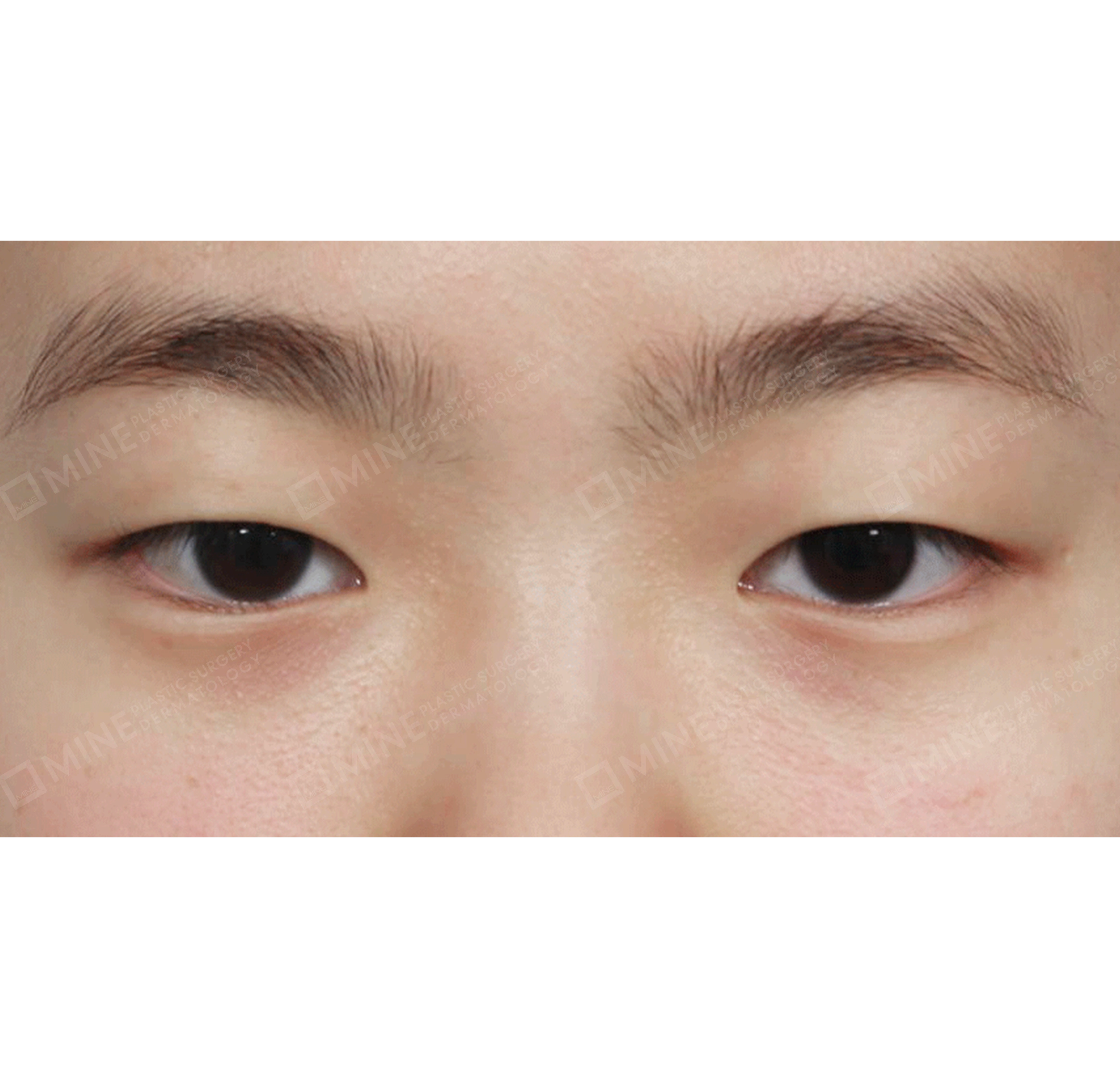 부분절개 + 앞트임 + 뒷트임 + 밑트임-전후-전