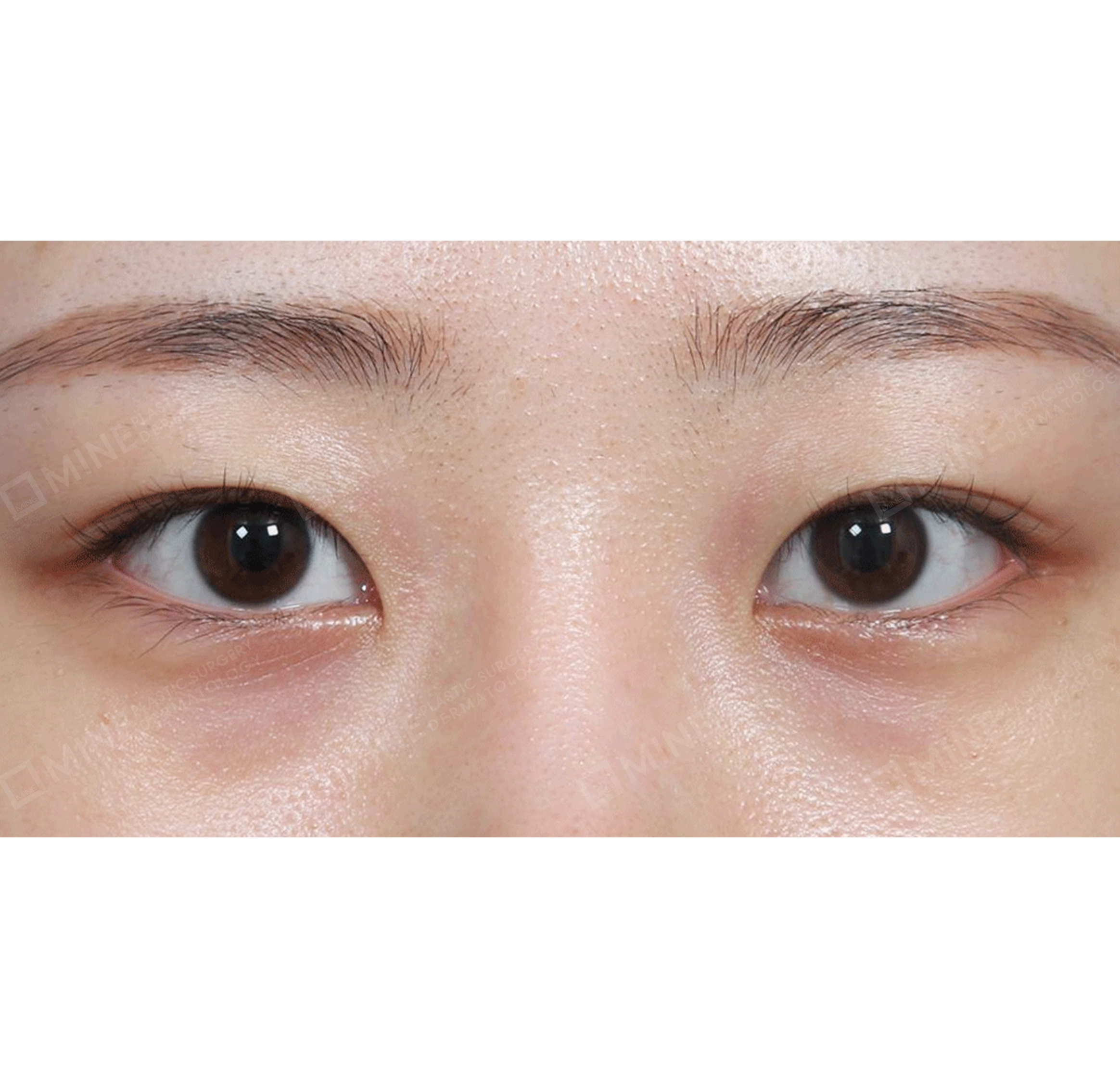 비절개눈매교정 + 앞트임-전후-전