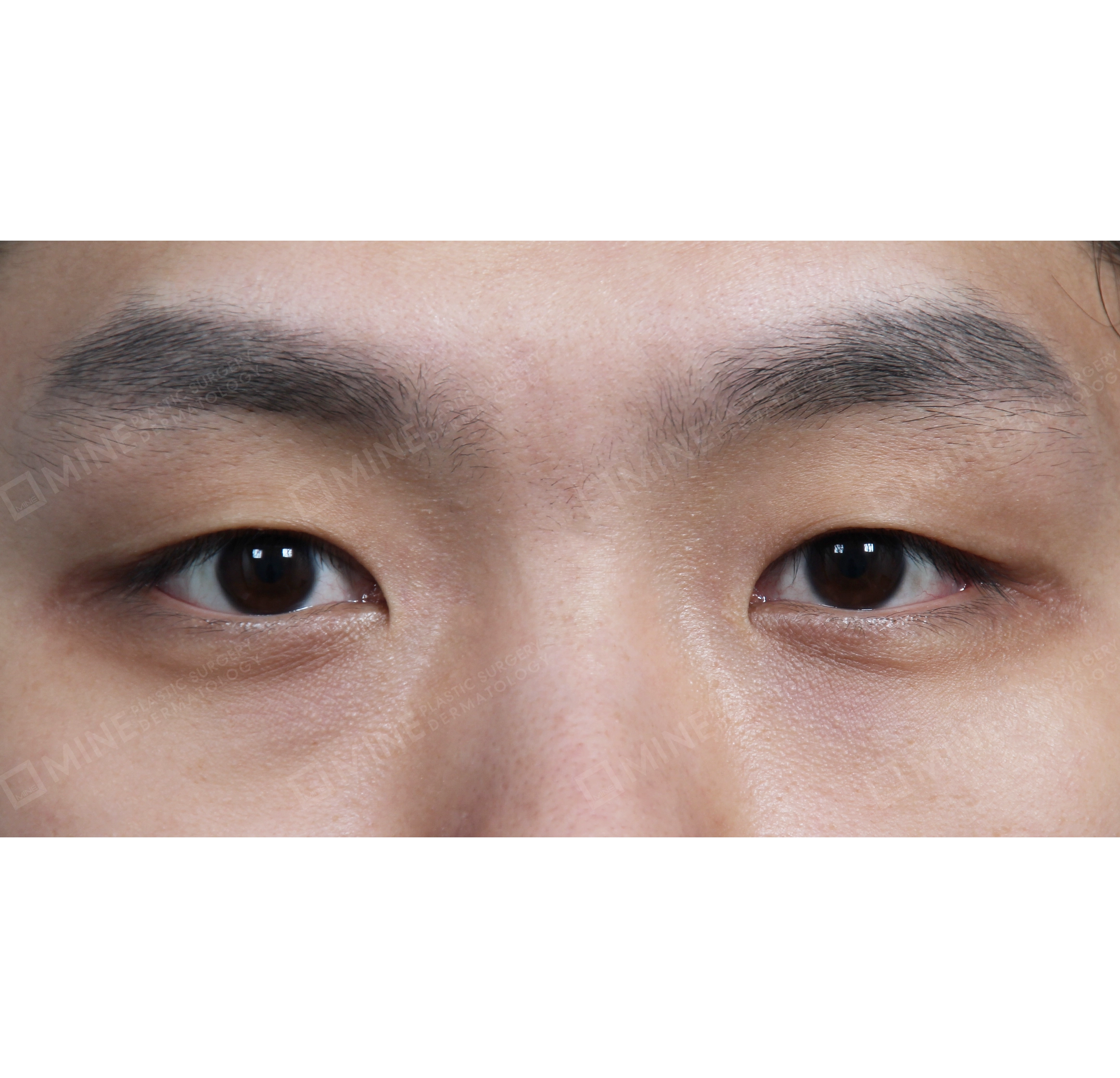 매몰 + 앞트임-전후-전