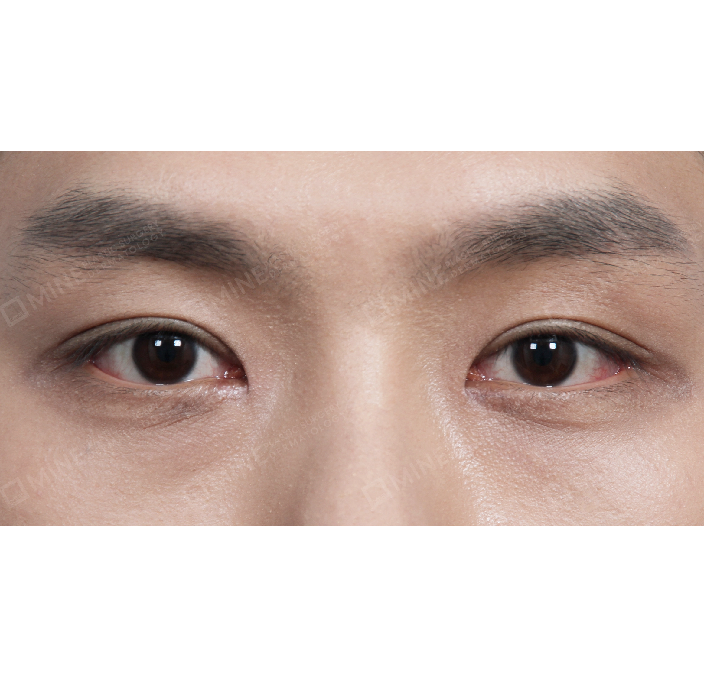 매몰 + 앞트임-전후-후