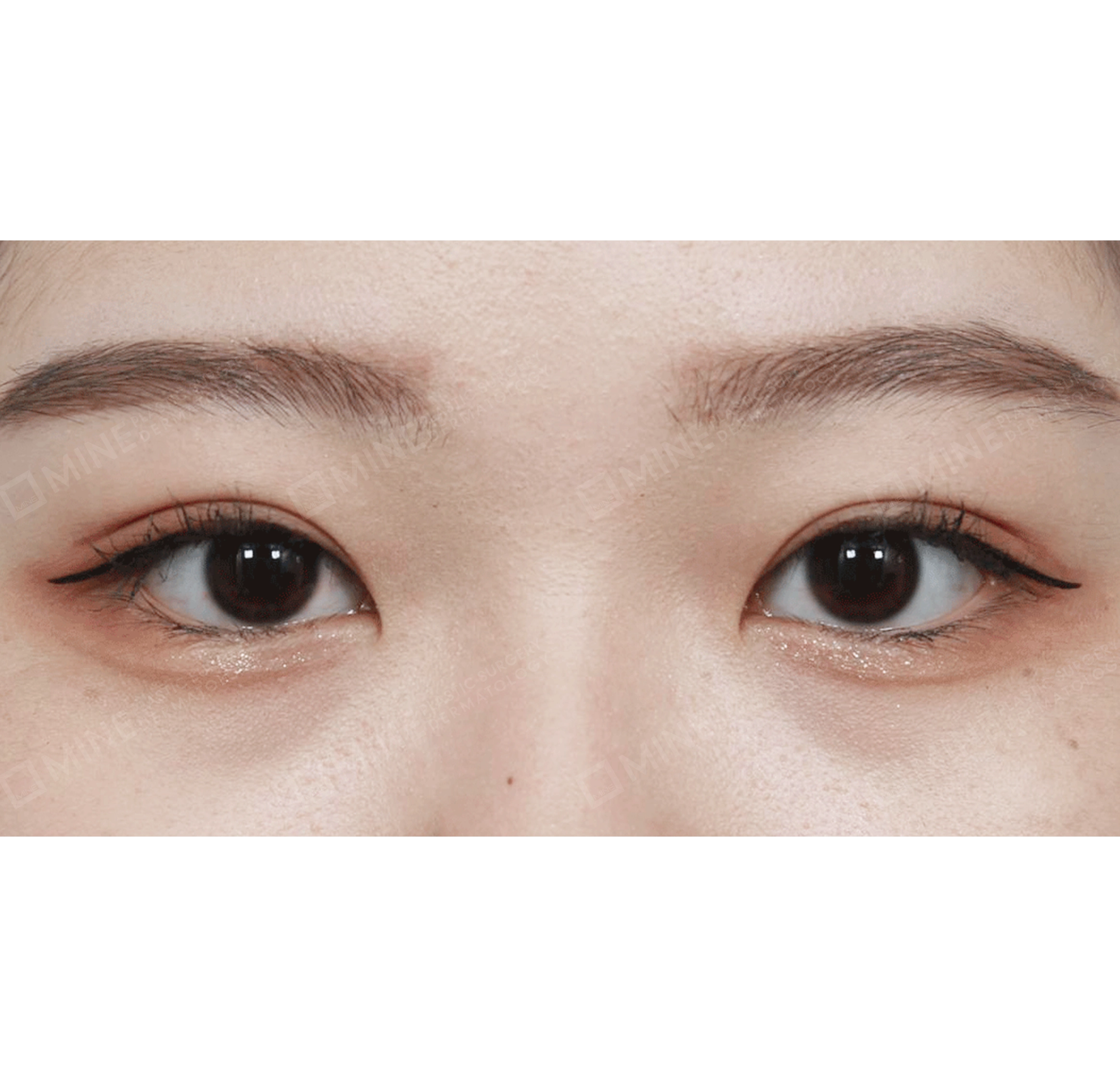 눈재수술 + 매몰눈매교정-전후-후