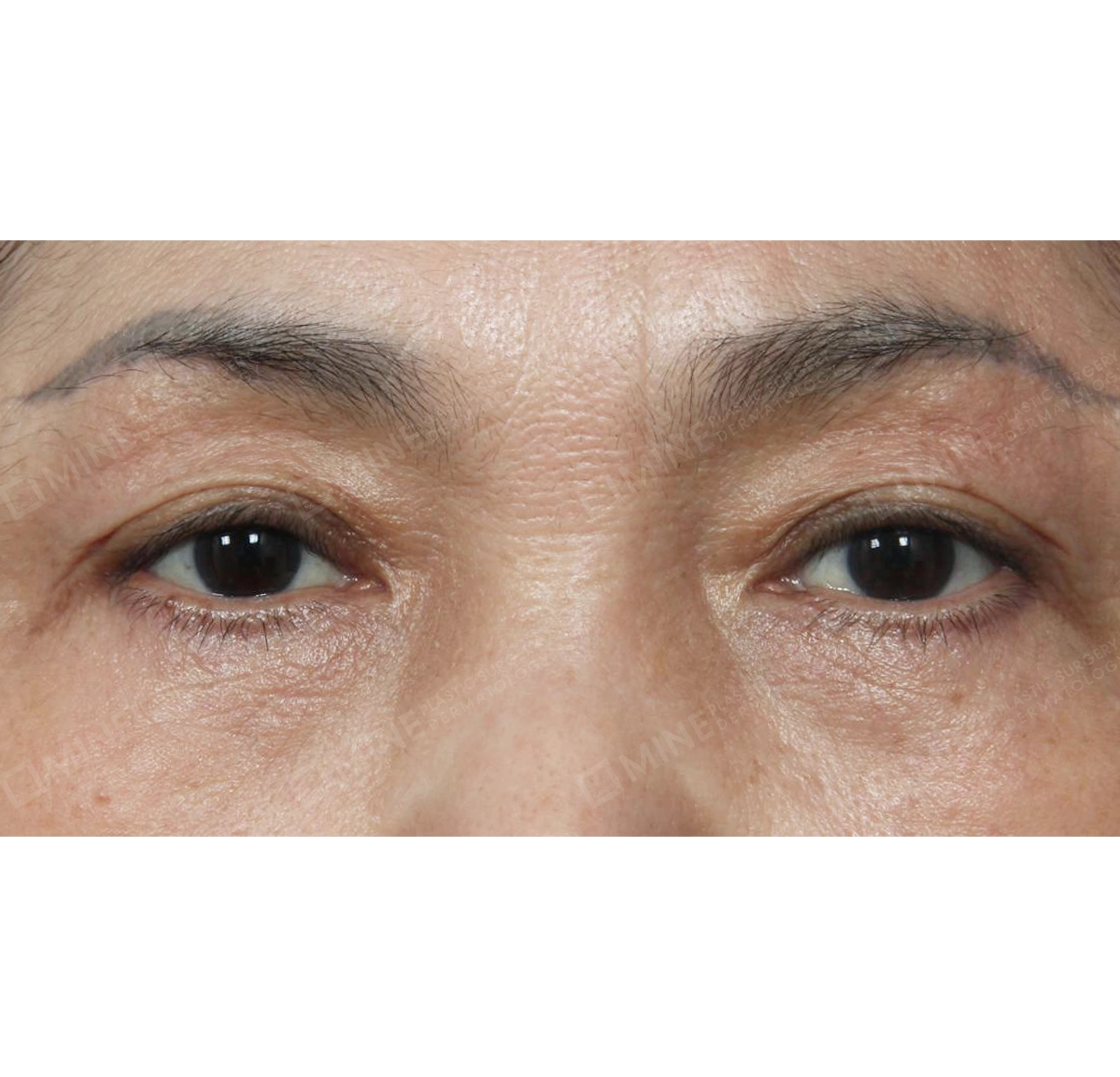 눈썹하거상 + 눈밑지방재배치-전후-후