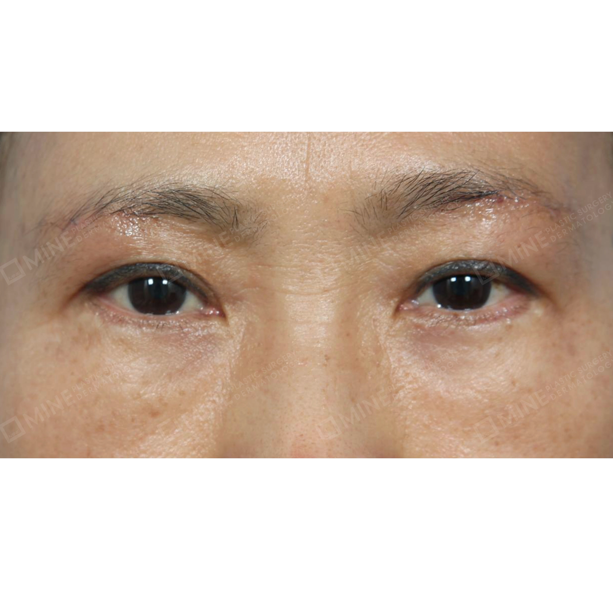 눈썹하거상 + 절개눈매교정-전후-후