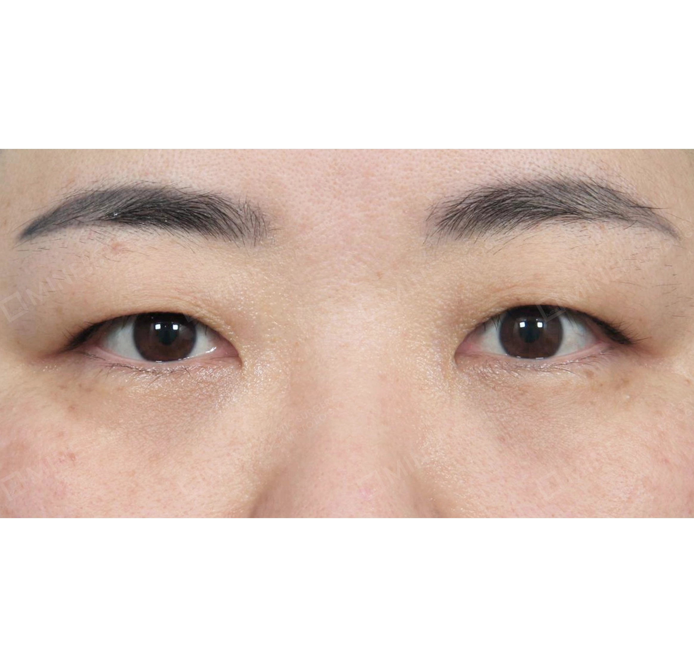 절개눈매교정-전후-전