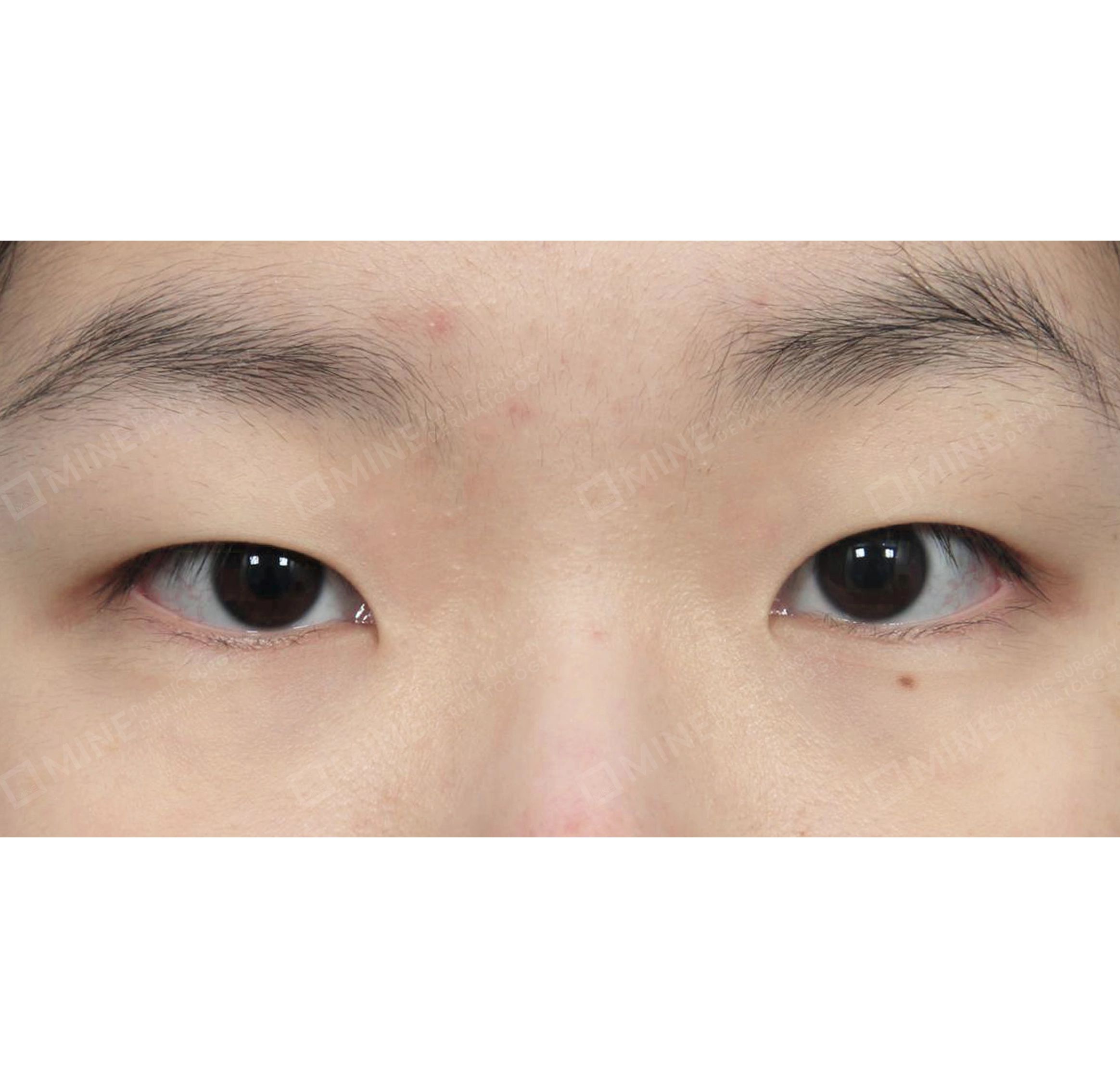 눈매교정-전후-전