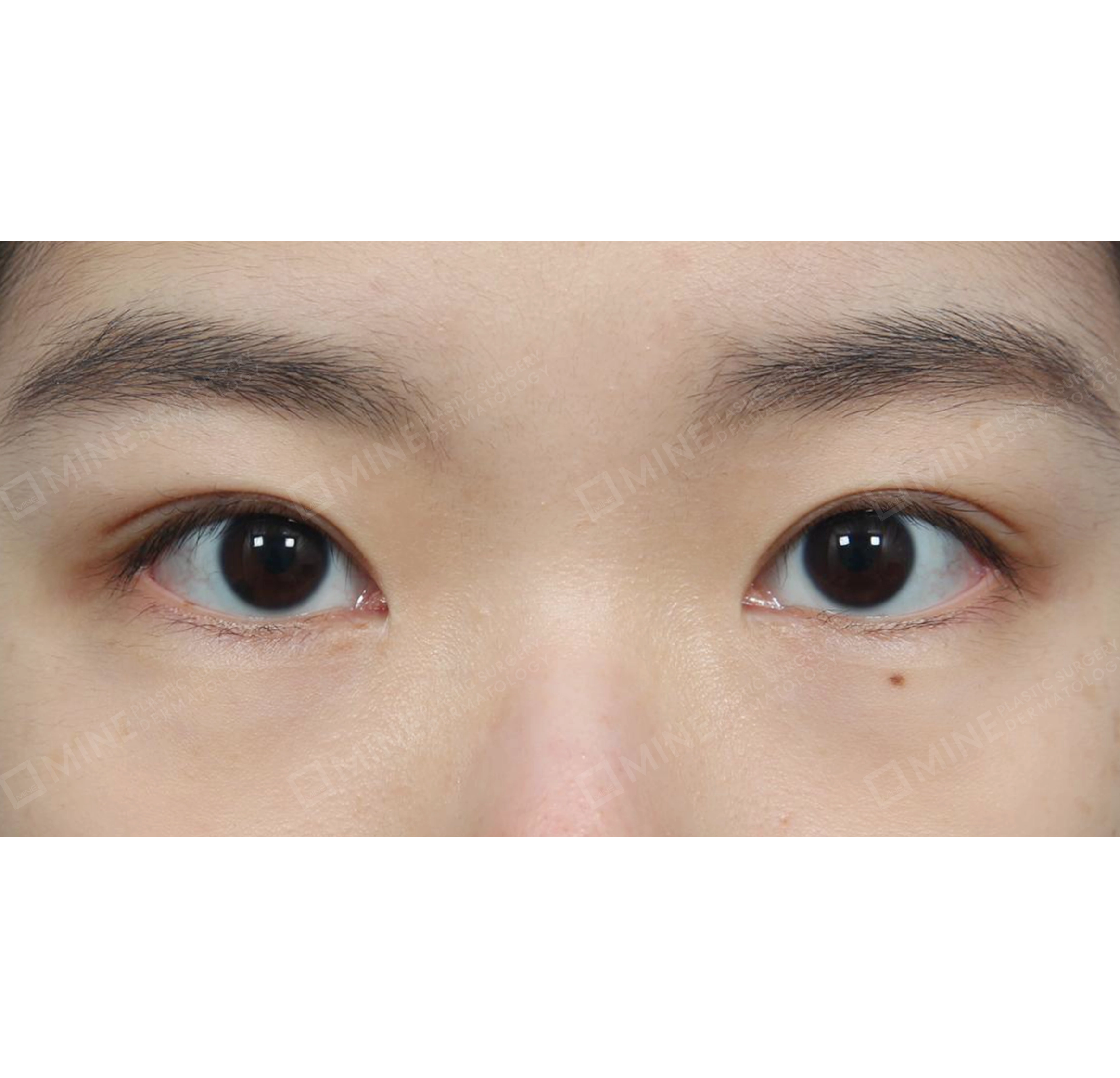 눈매교정-전후-후