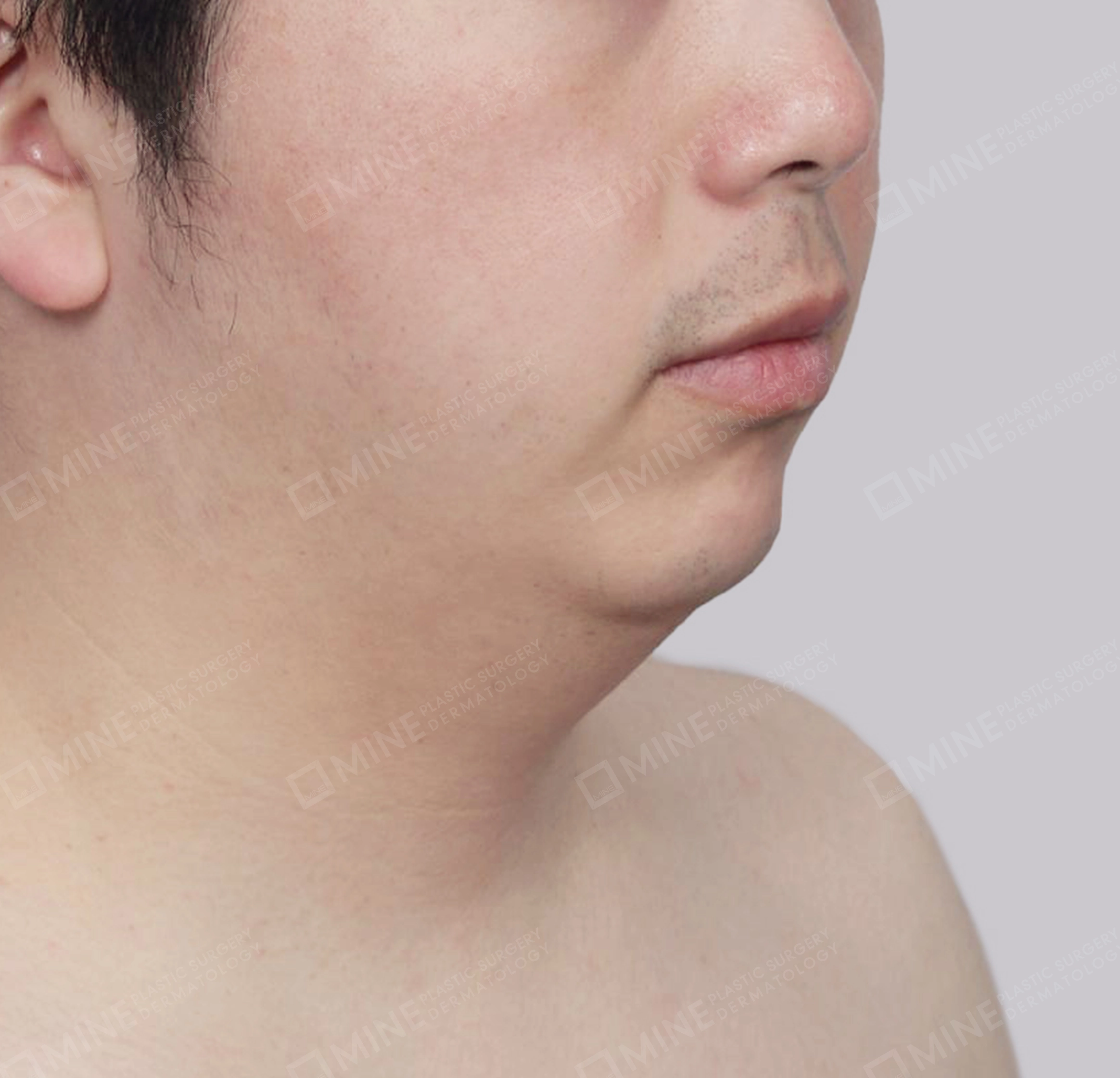 이중턱 근육묶기-전후-전