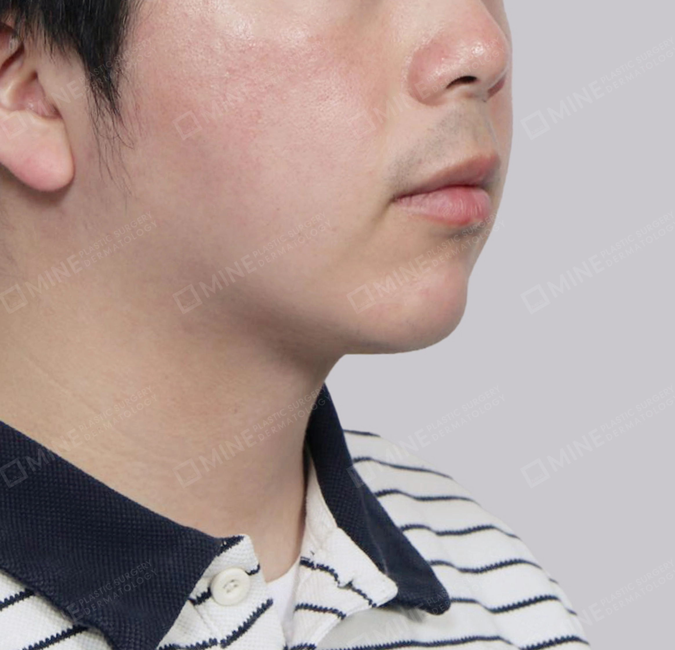 이중턱 근육묶기-전후-후