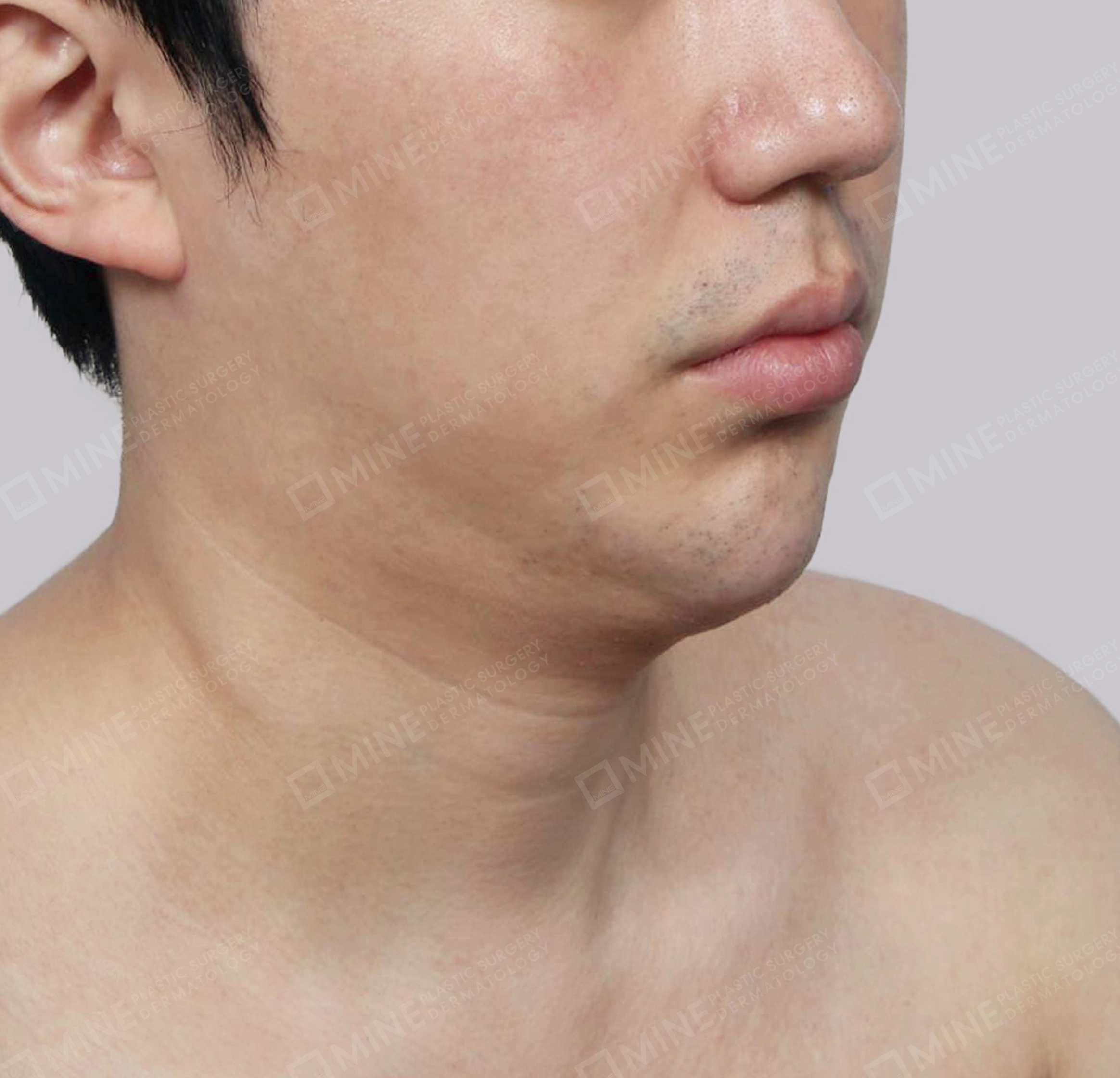 이중턱 근육묶기-전후-전
