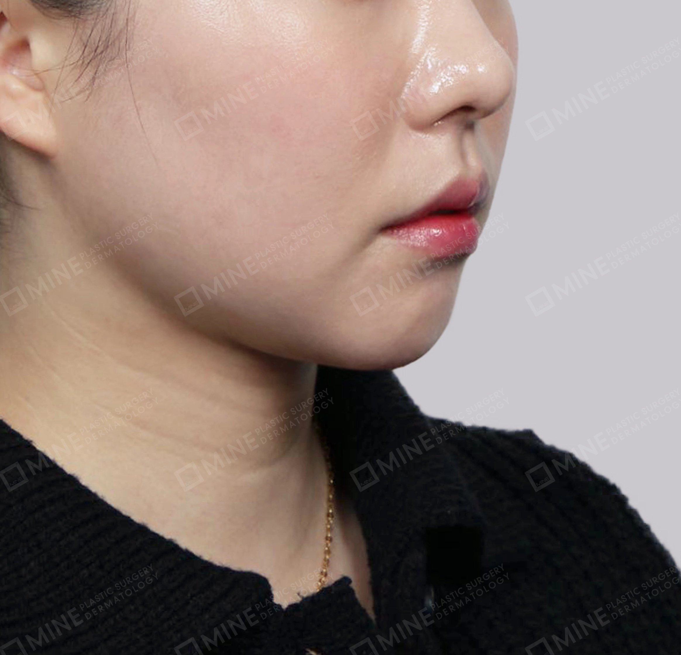 이중턱 근육묶기-전후-후