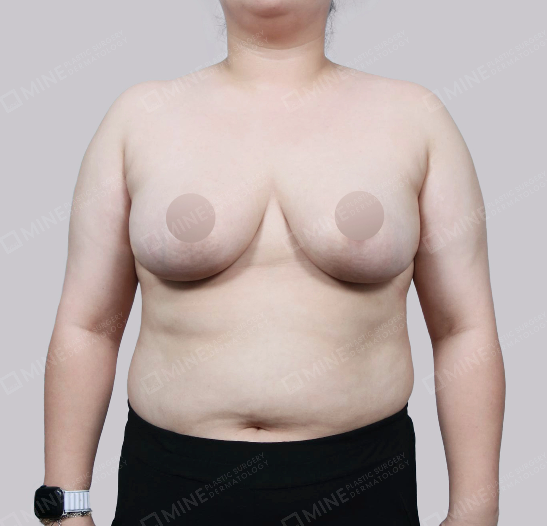 가슴축소-전후-후