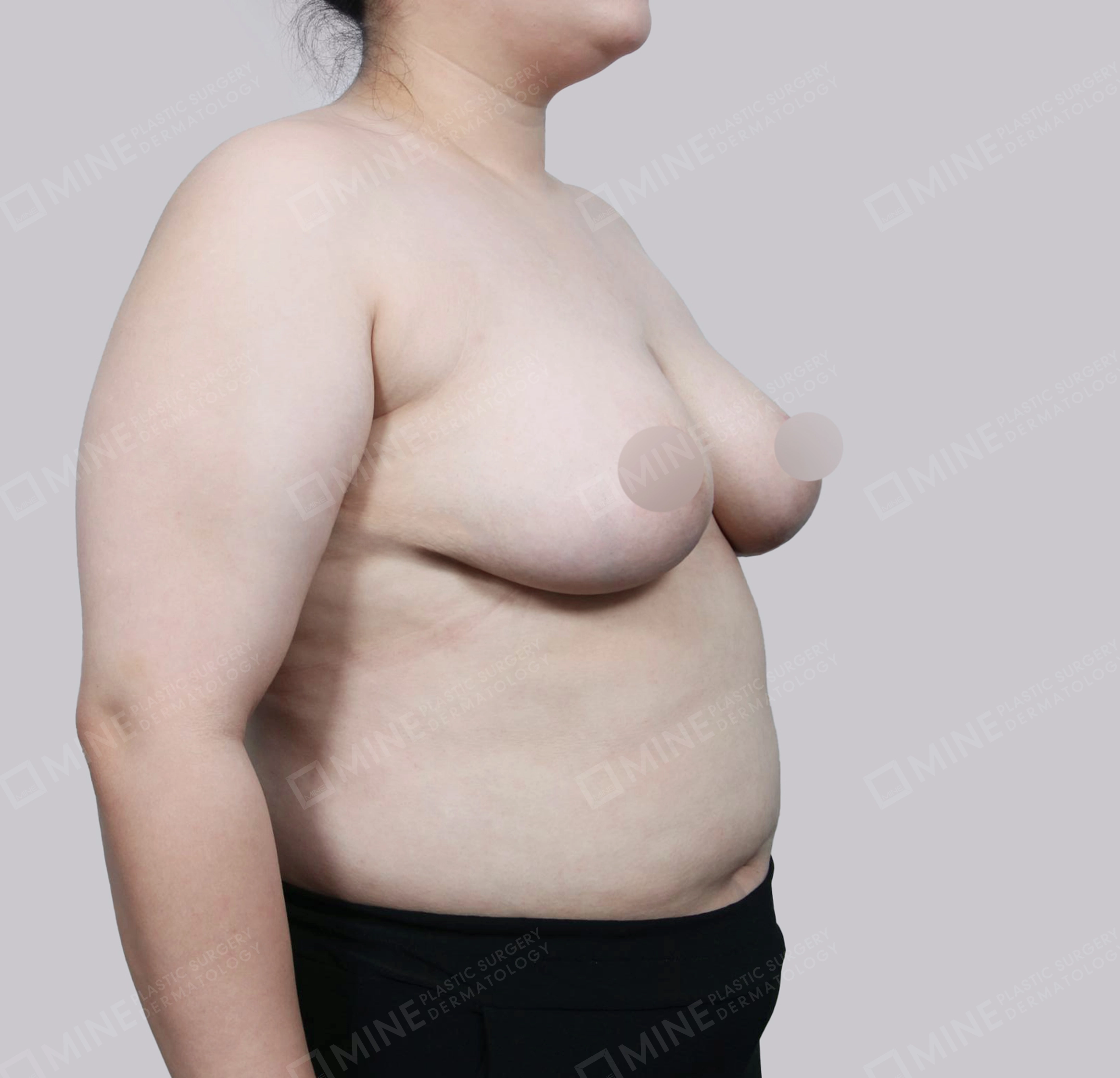 가슴축소-45도-후