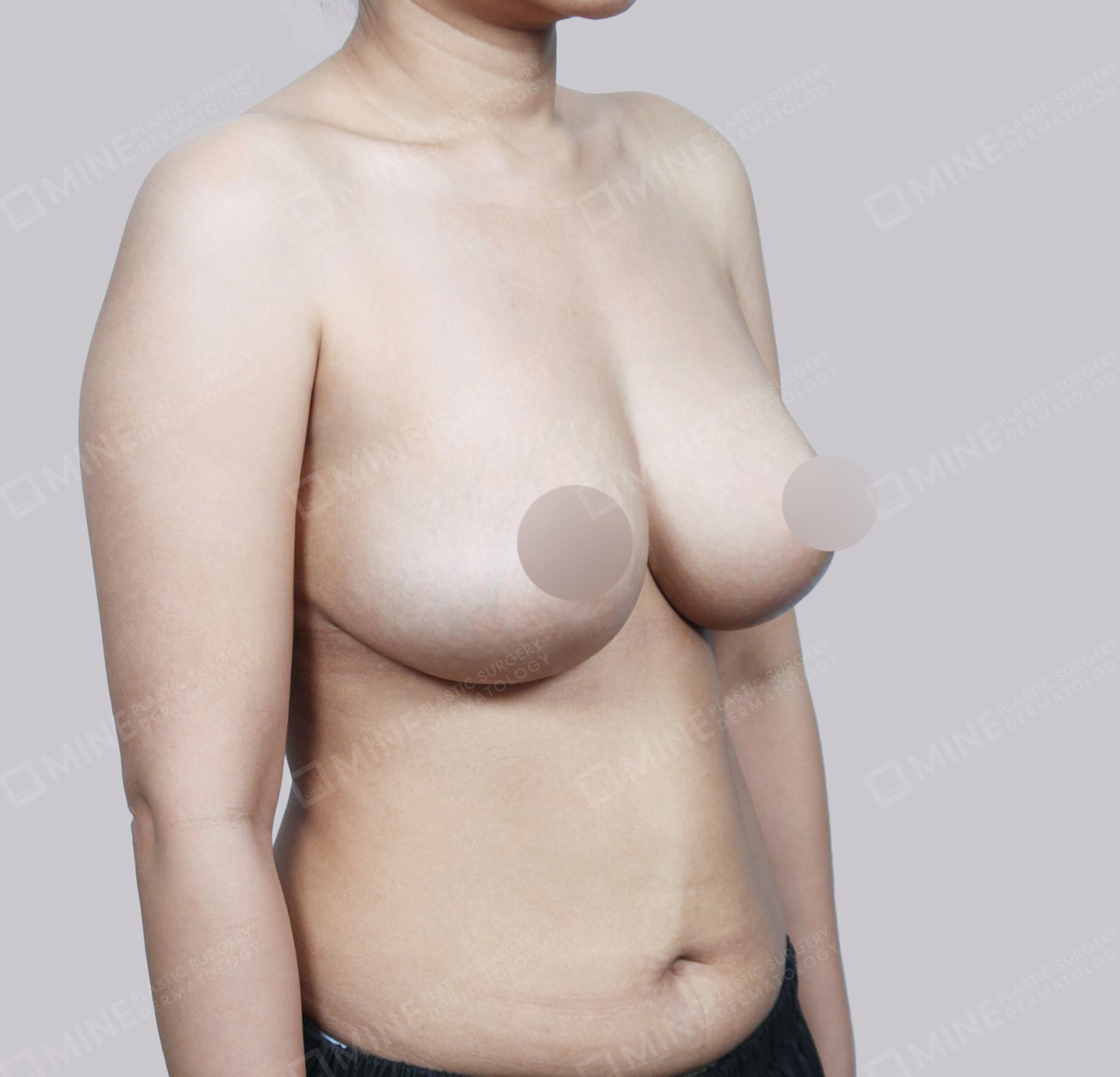 가슴축소-45도-후