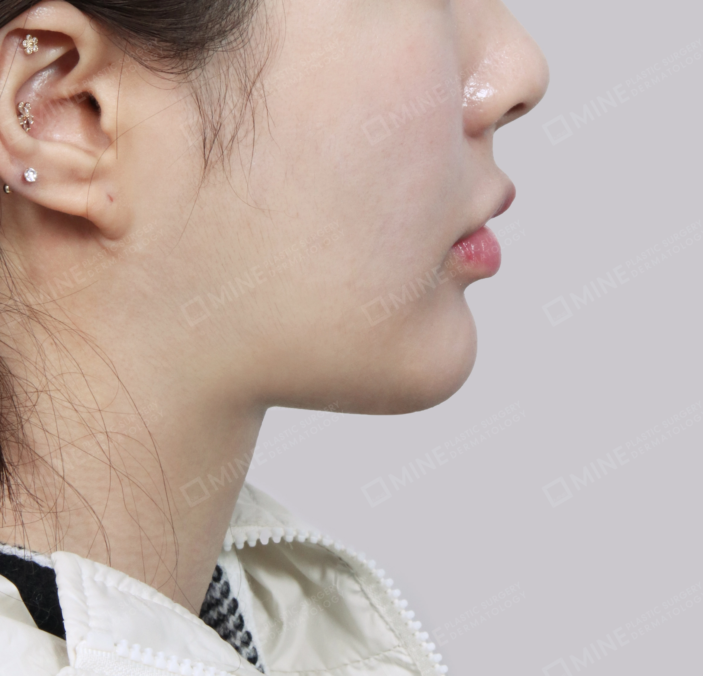 이중턱 침샘제거-측면-후