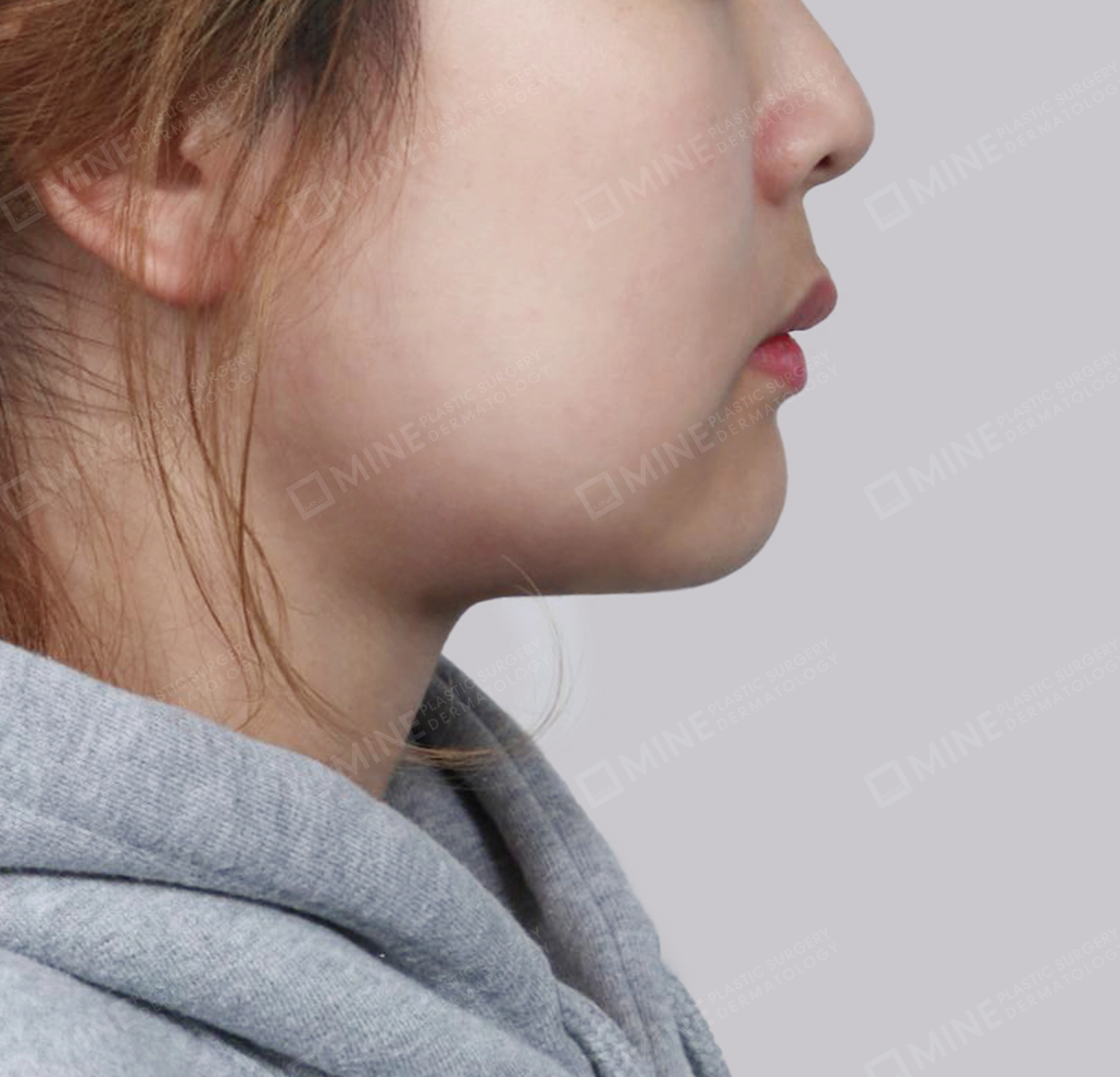 이중턱 침샘제거-측면-후