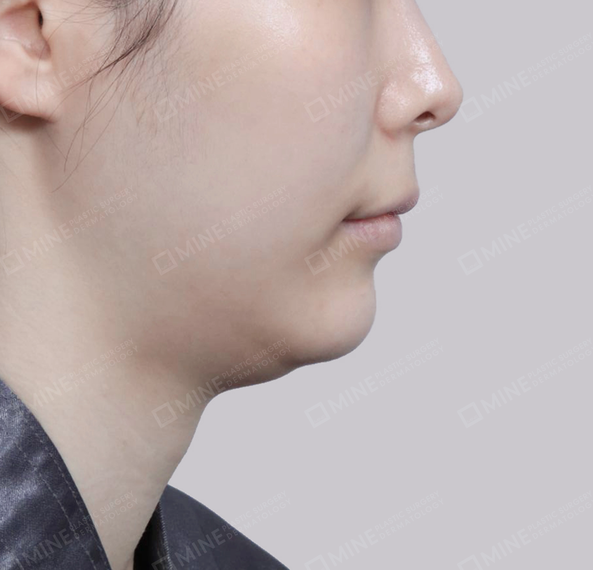 이중턱 침샘제거-측면-전