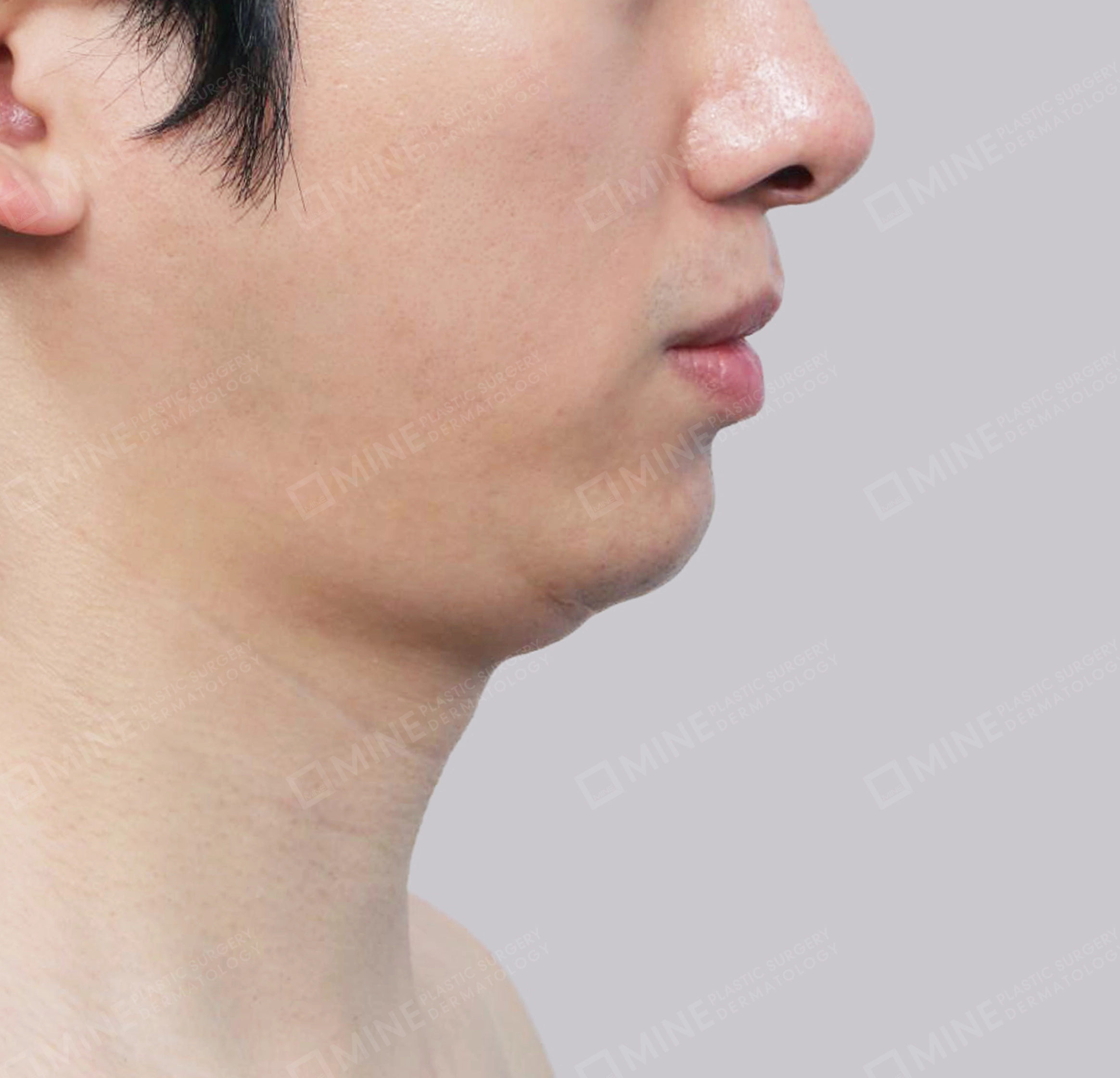 이중턱 침샘제거-측면-전