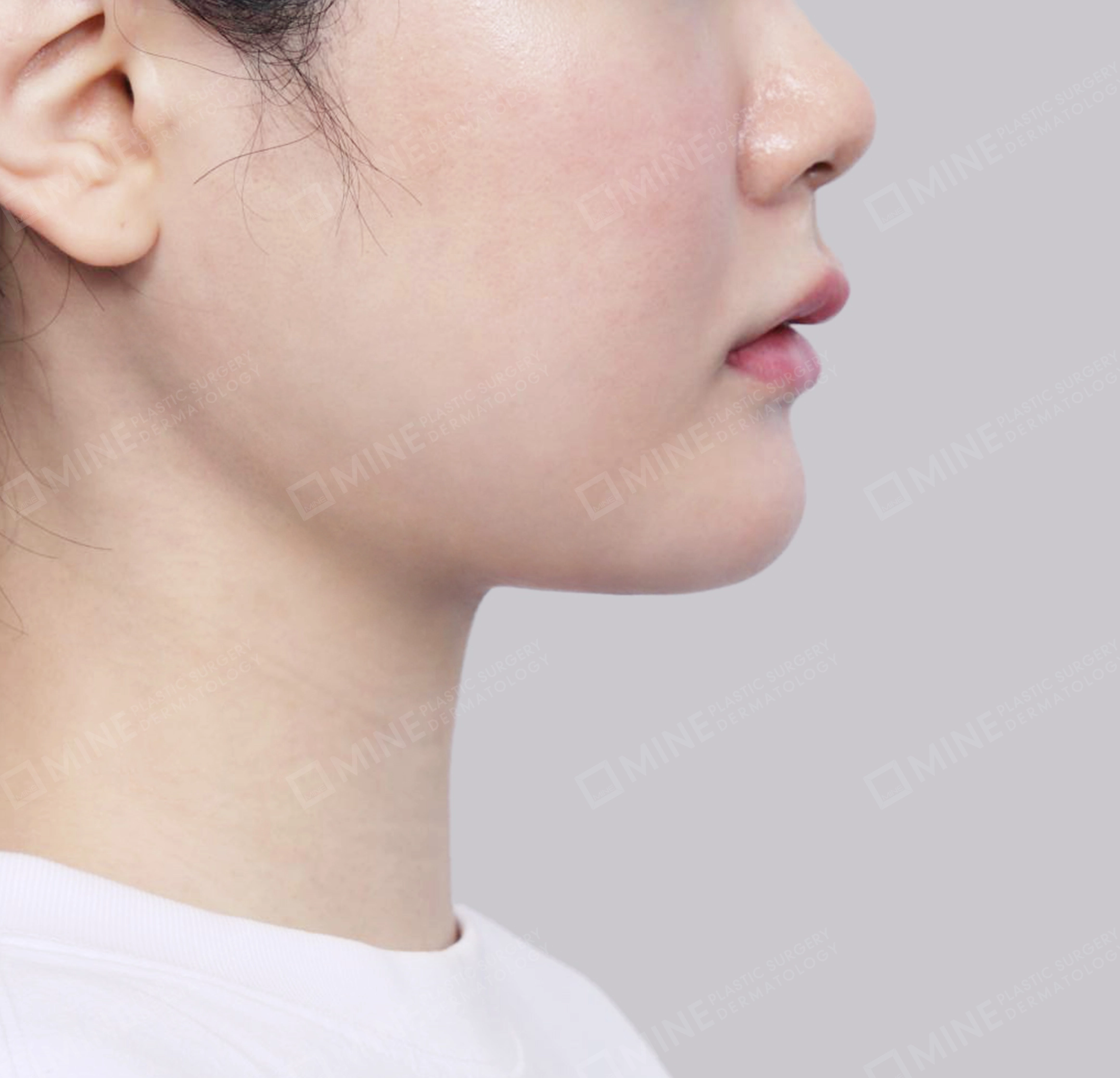 이중턱 침샘제거-측면-후