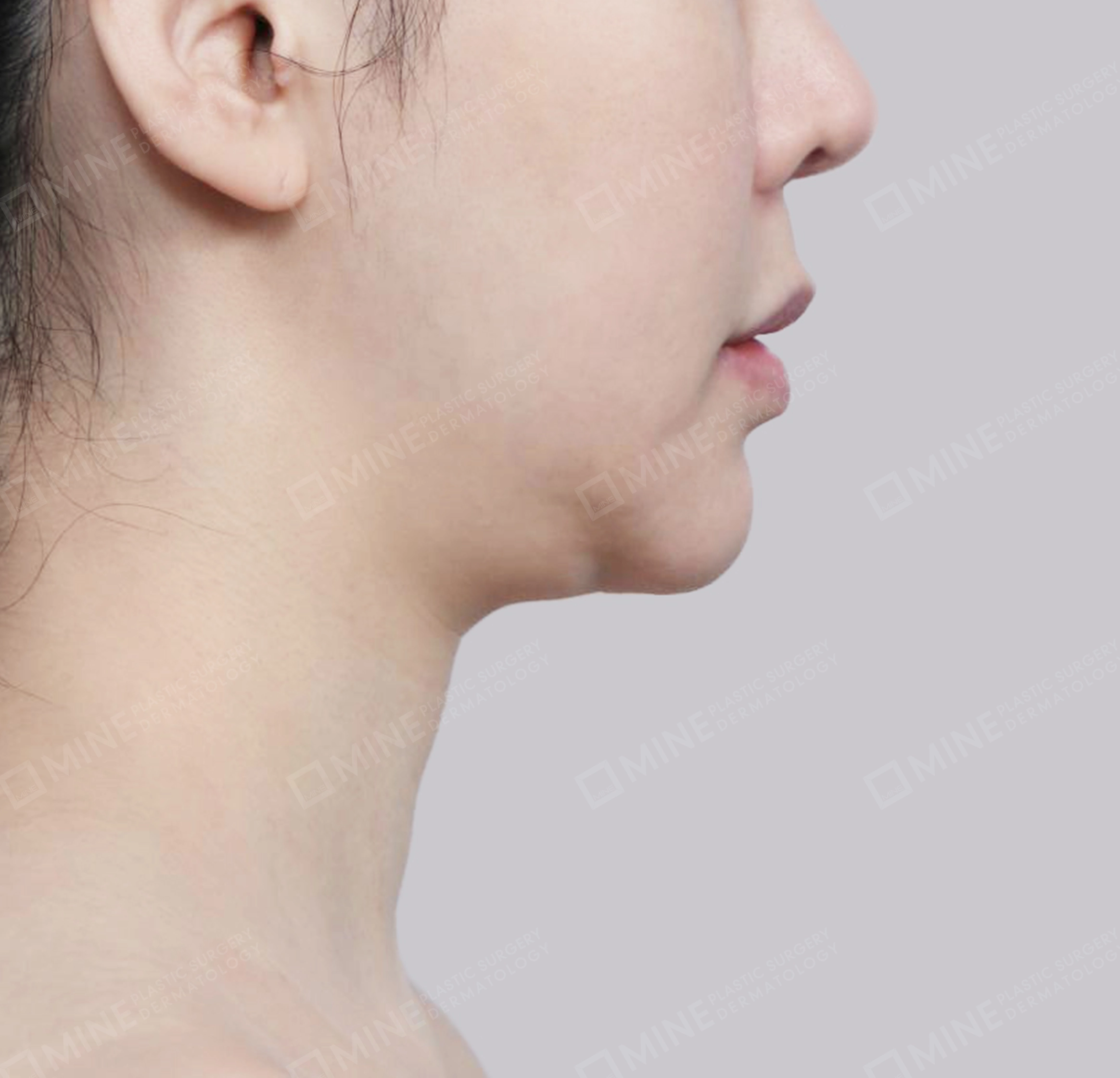 이중턱 침샘제거-측면-전