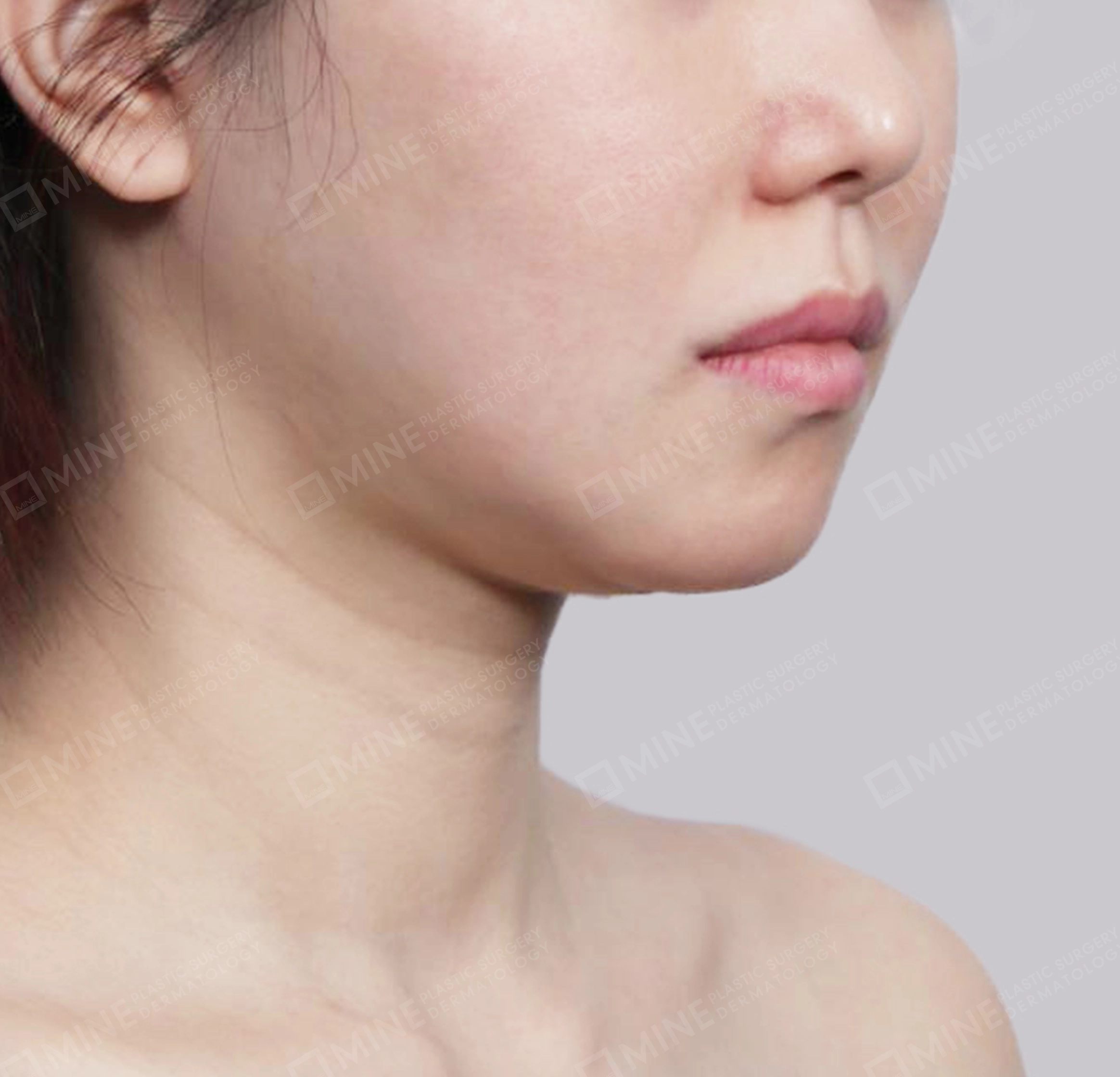 이중턱 침샘제거-전후-전