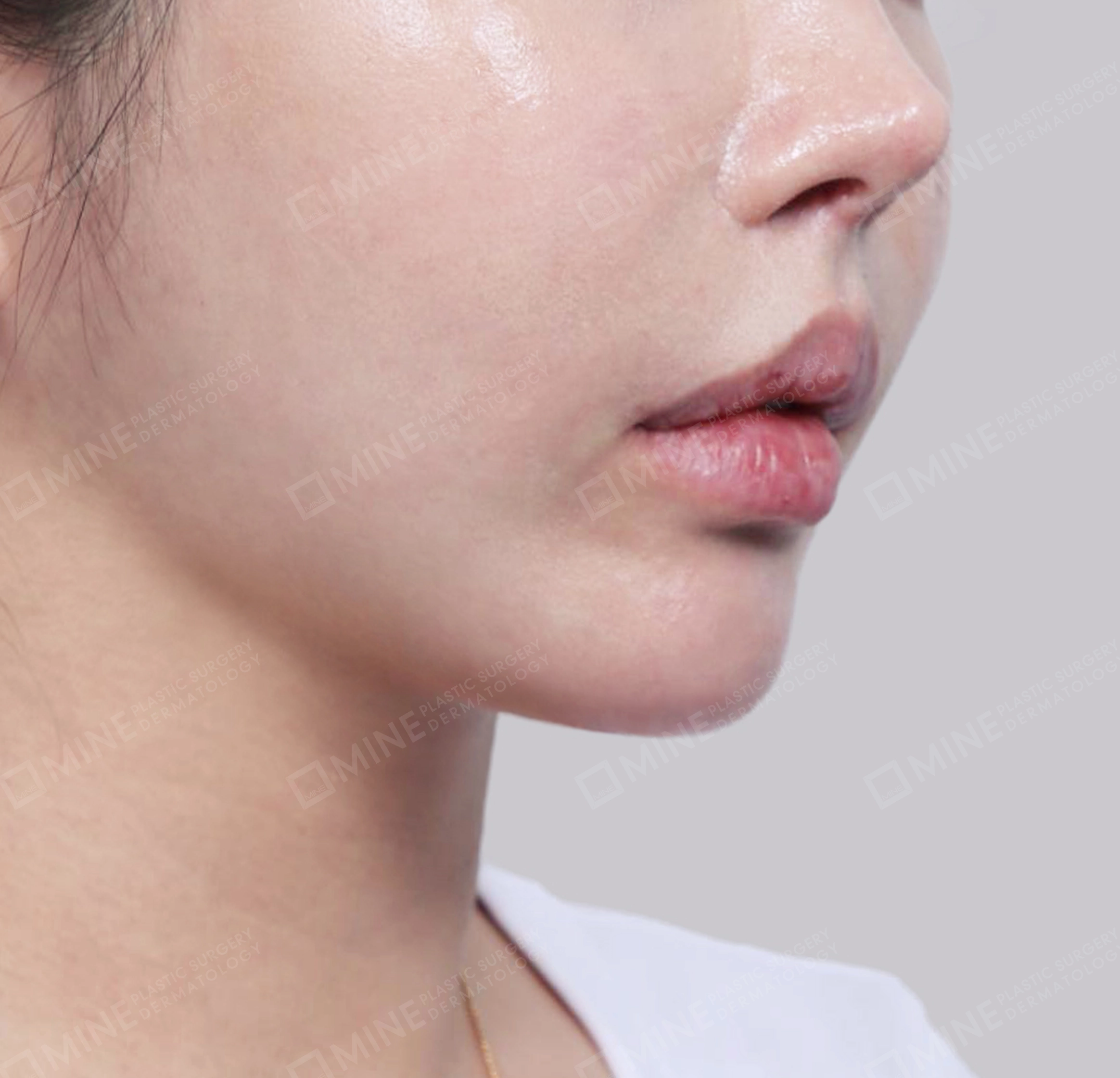 이중턱 침샘제거-전후-후