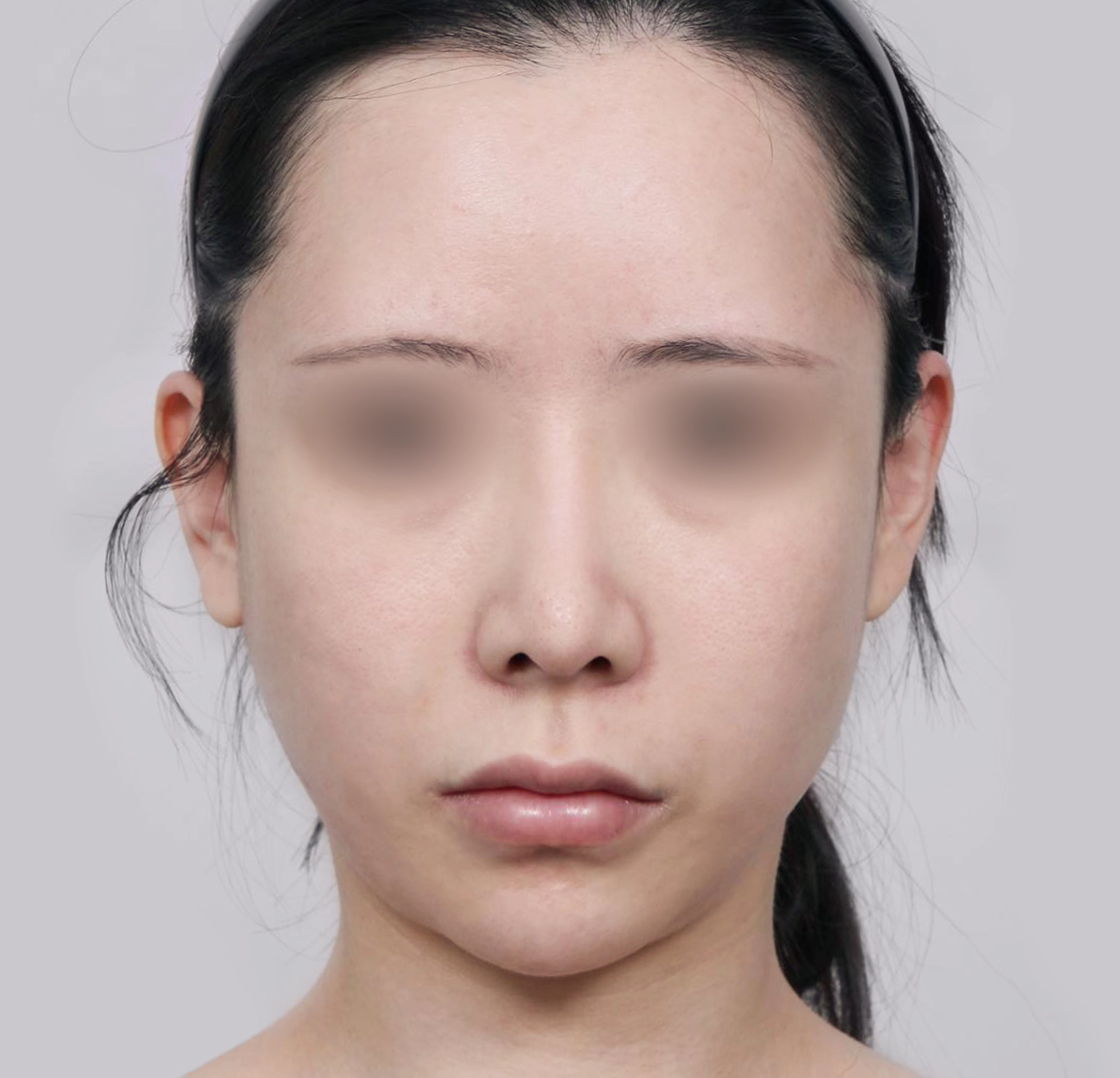 미니안면거상-전후-전