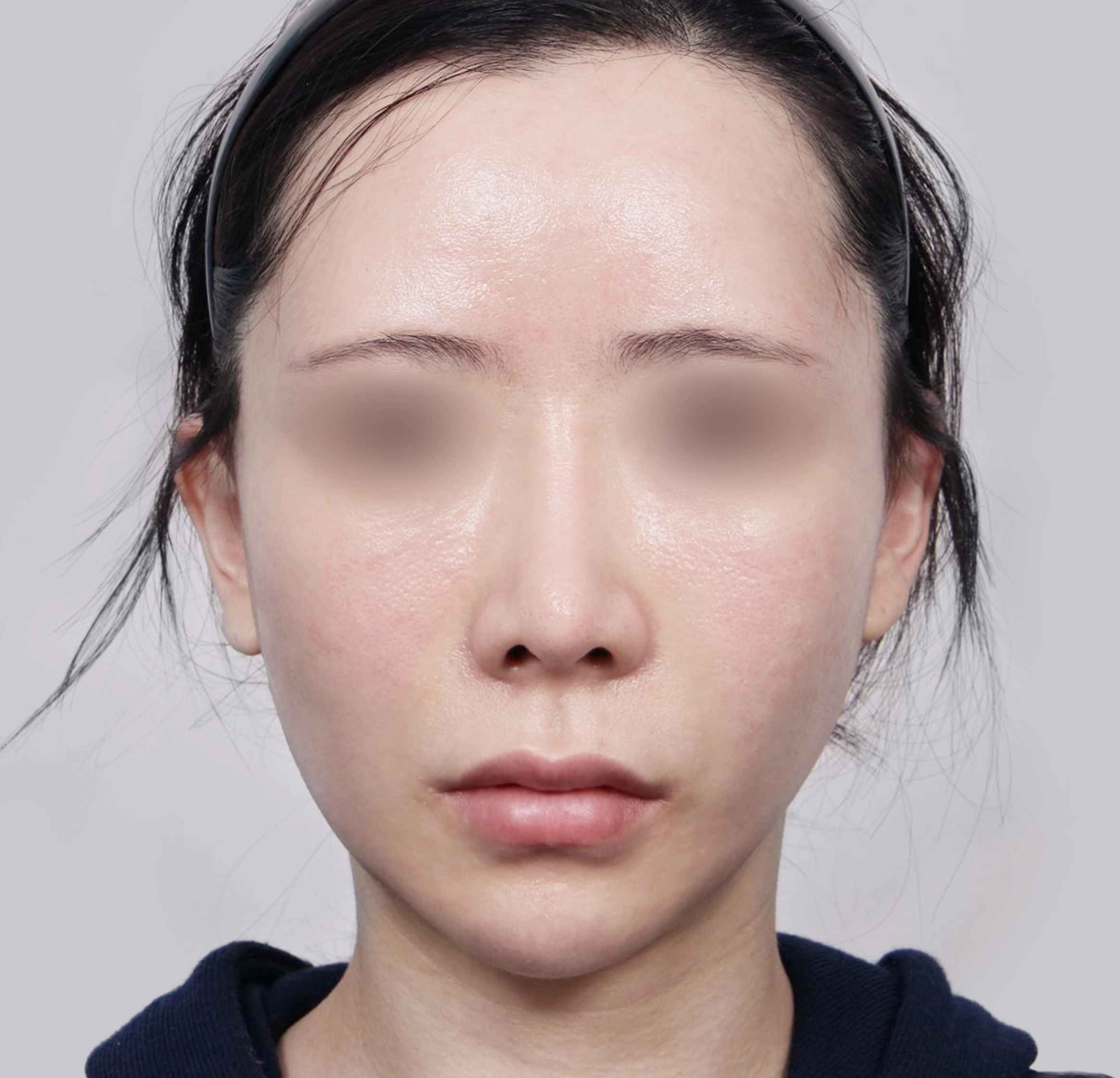 미니안면거상-전후-후