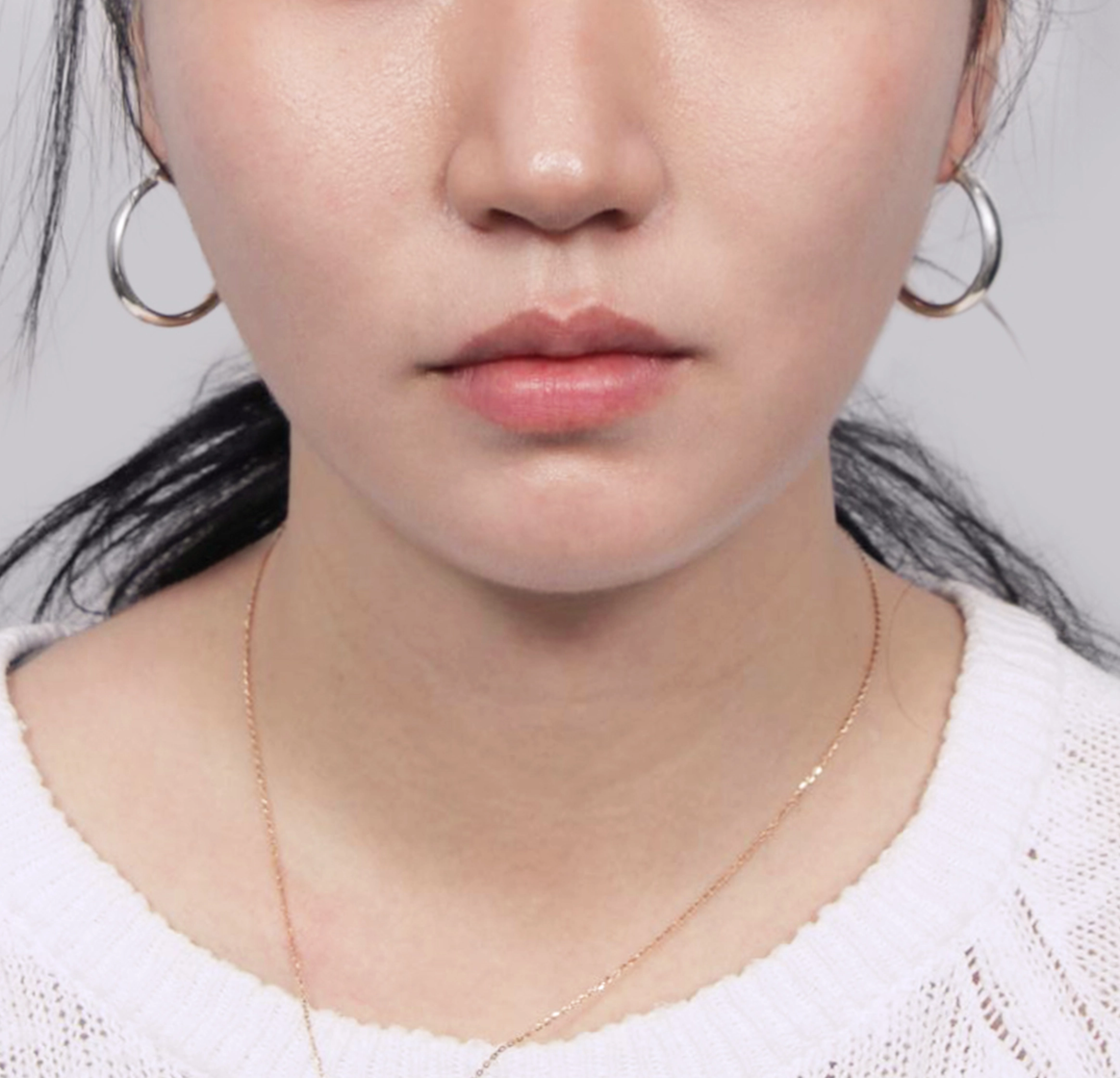 미니안면거상-전후-후