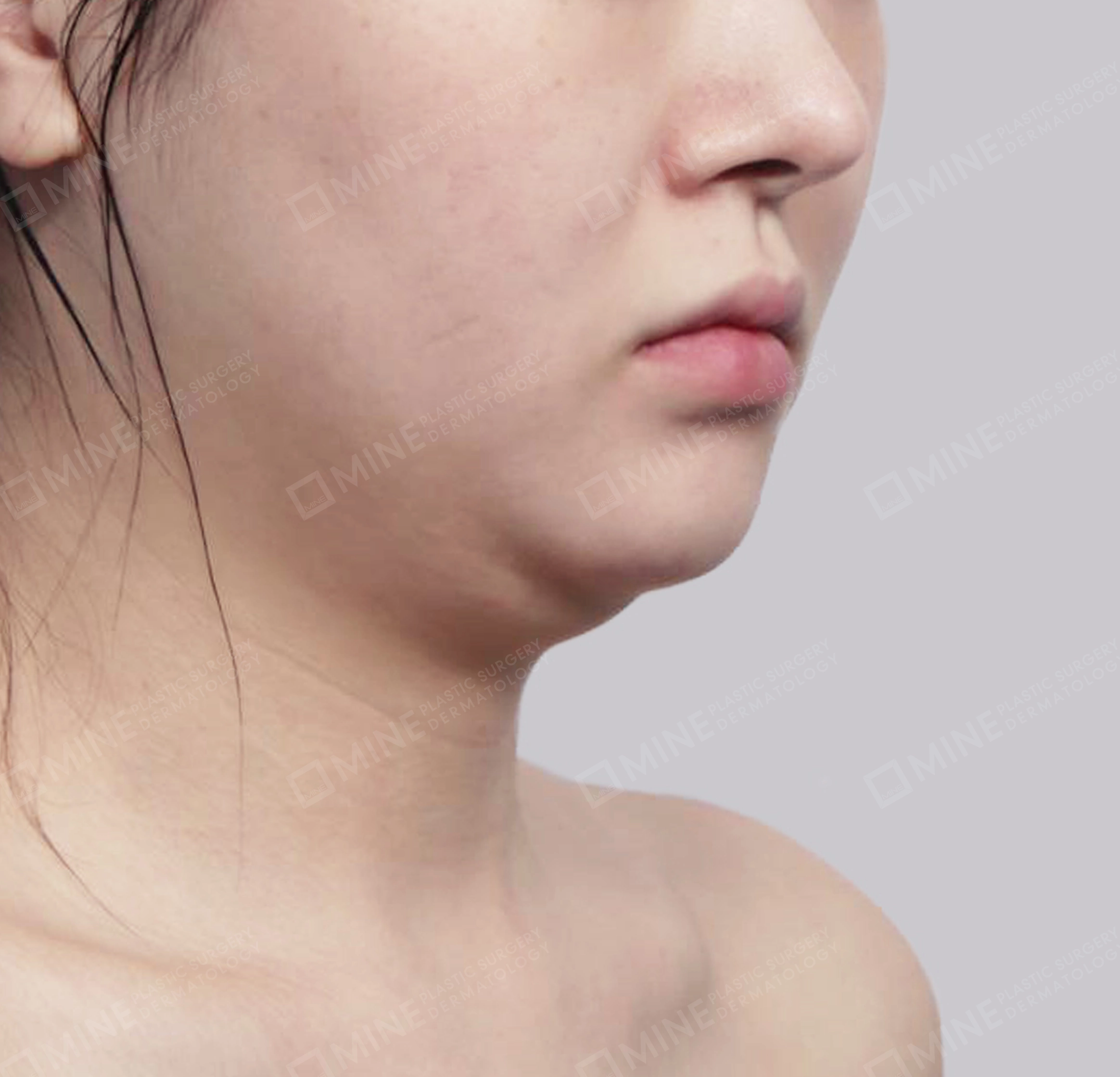 이중턱 근육묶기 + 근육하 지방제거-전후-전