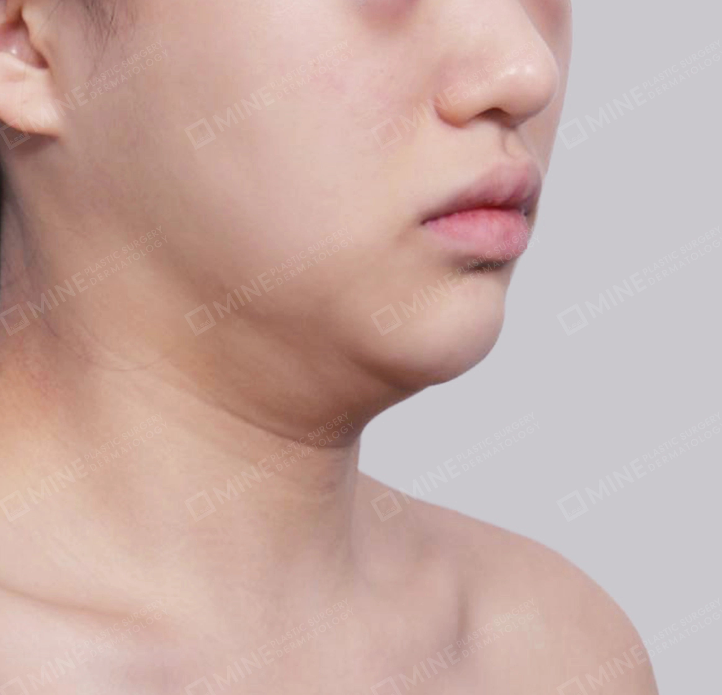 이중턱 근육묶기 + 근육하 지방제거-전후-전
