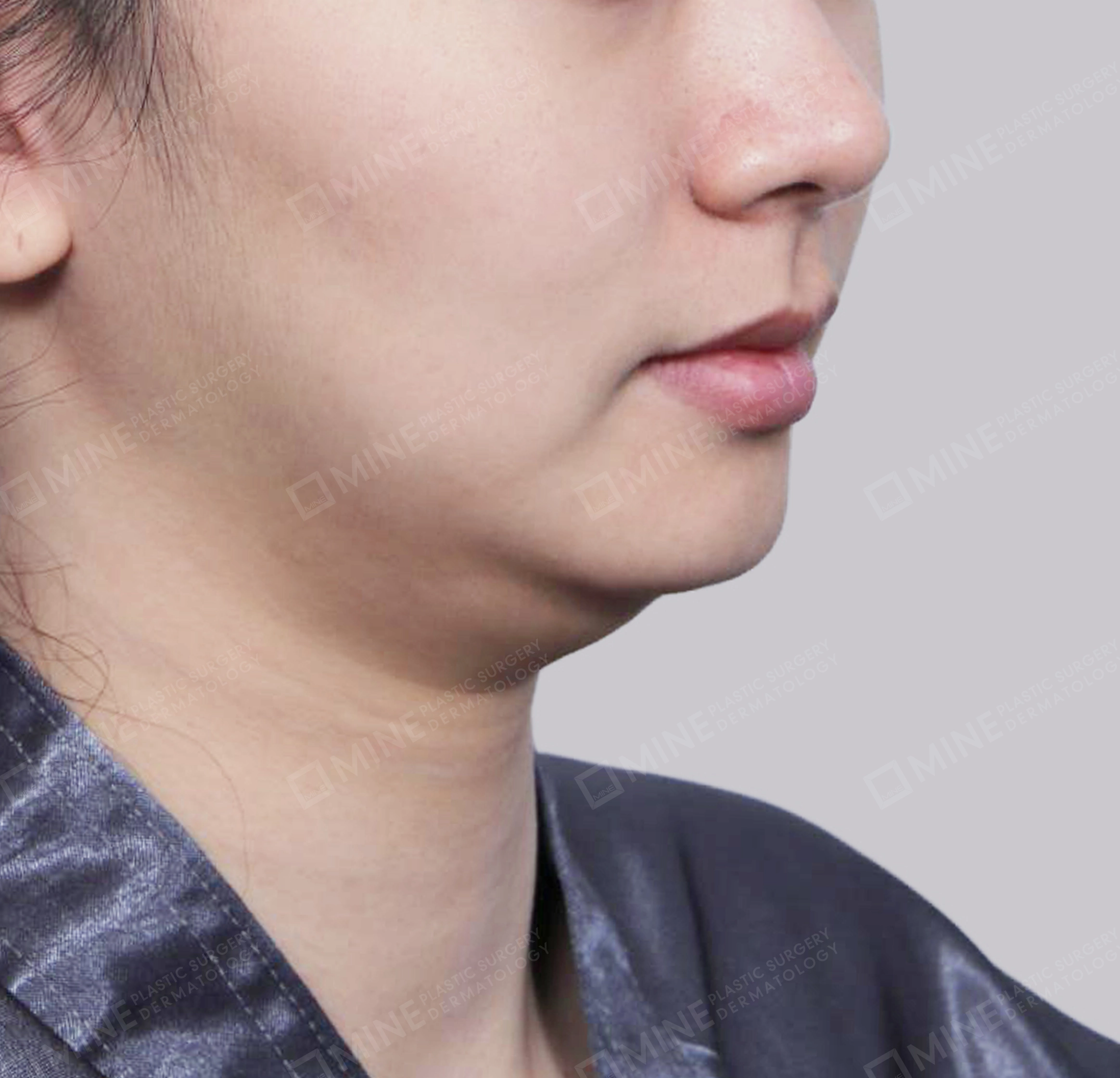 이중턱 근육묶기 + 근육하 지방제거-전후-전