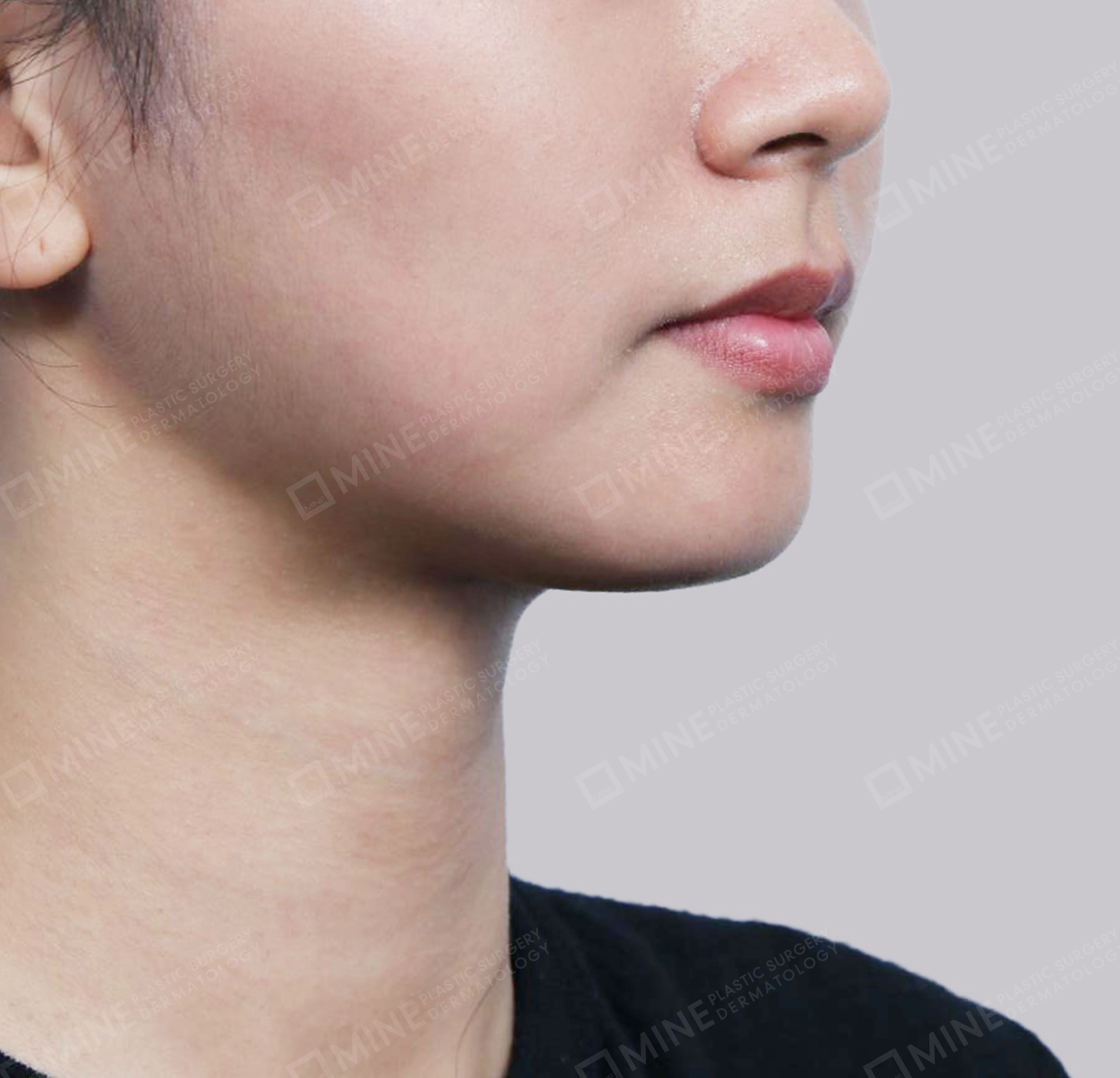 이중턱 근육묶기 + 근육하 지방제거-전후-후