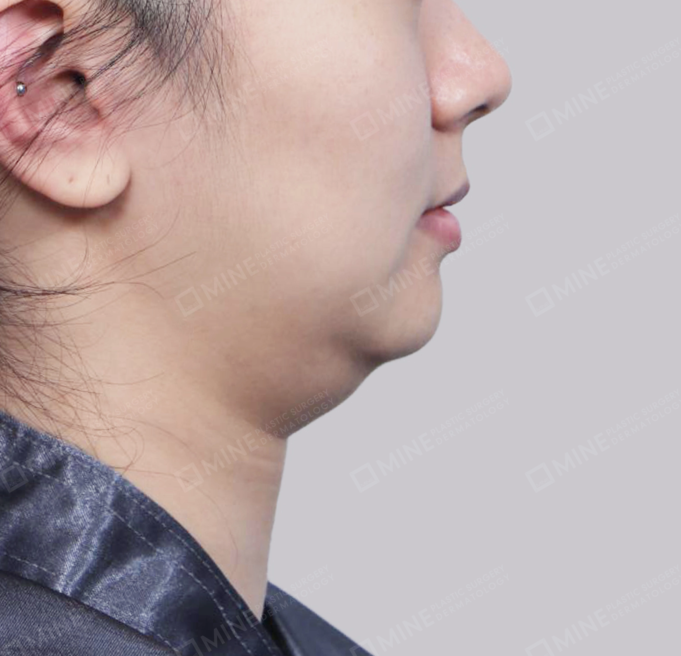 이중턱 근육묶기 + 근육하 지방제거-측면-전