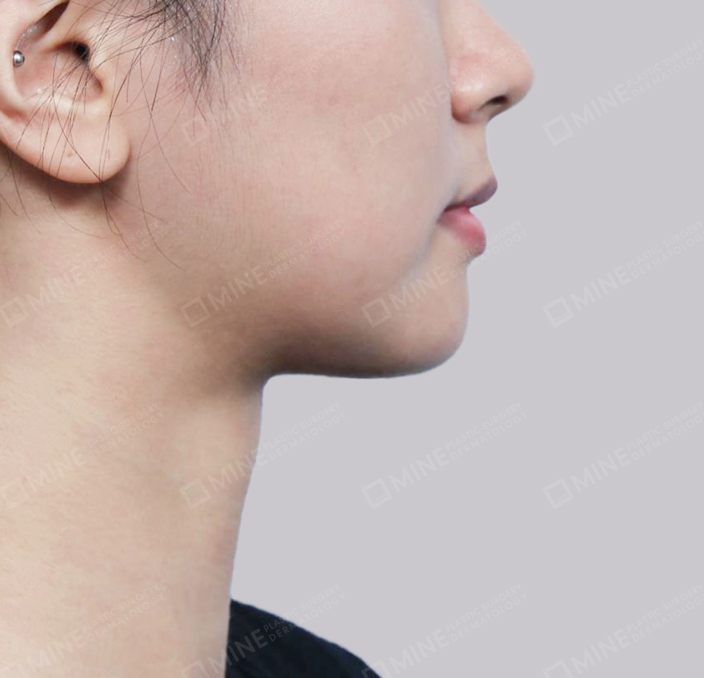 이중턱 근육묶기 + 근육하 지방제거-측면-후