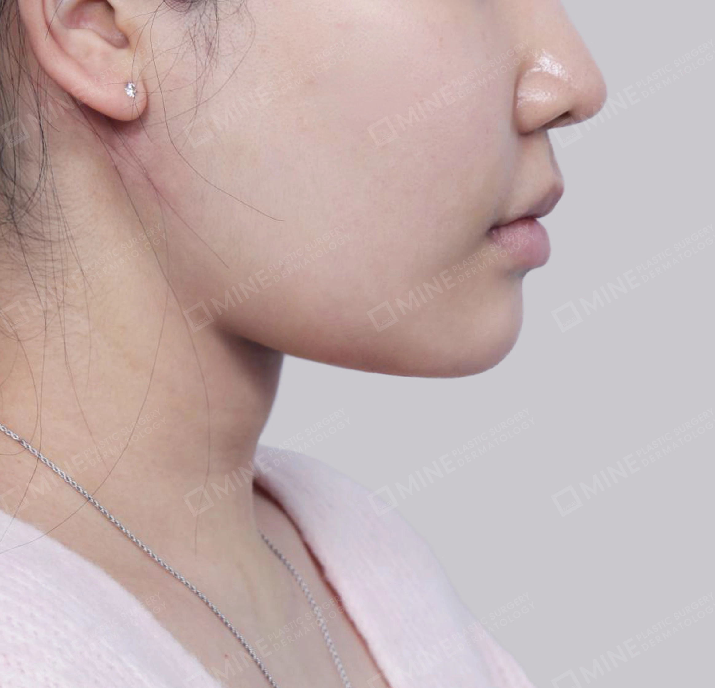 이중턱 근육묶기 + 근육하 지방제거-측면-후