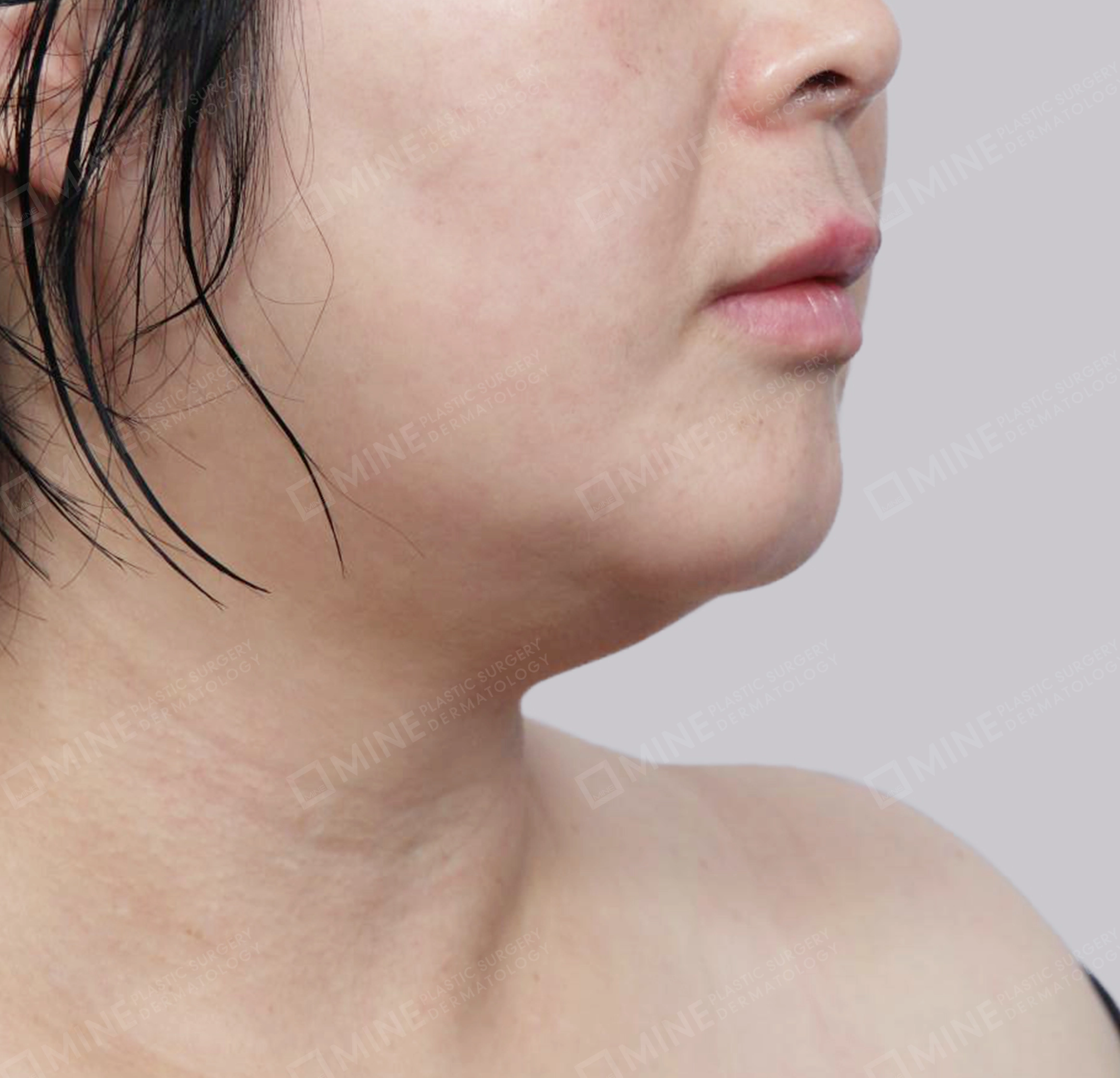 이중턱 근육묶기 + 근육하 지방제거-전후-전