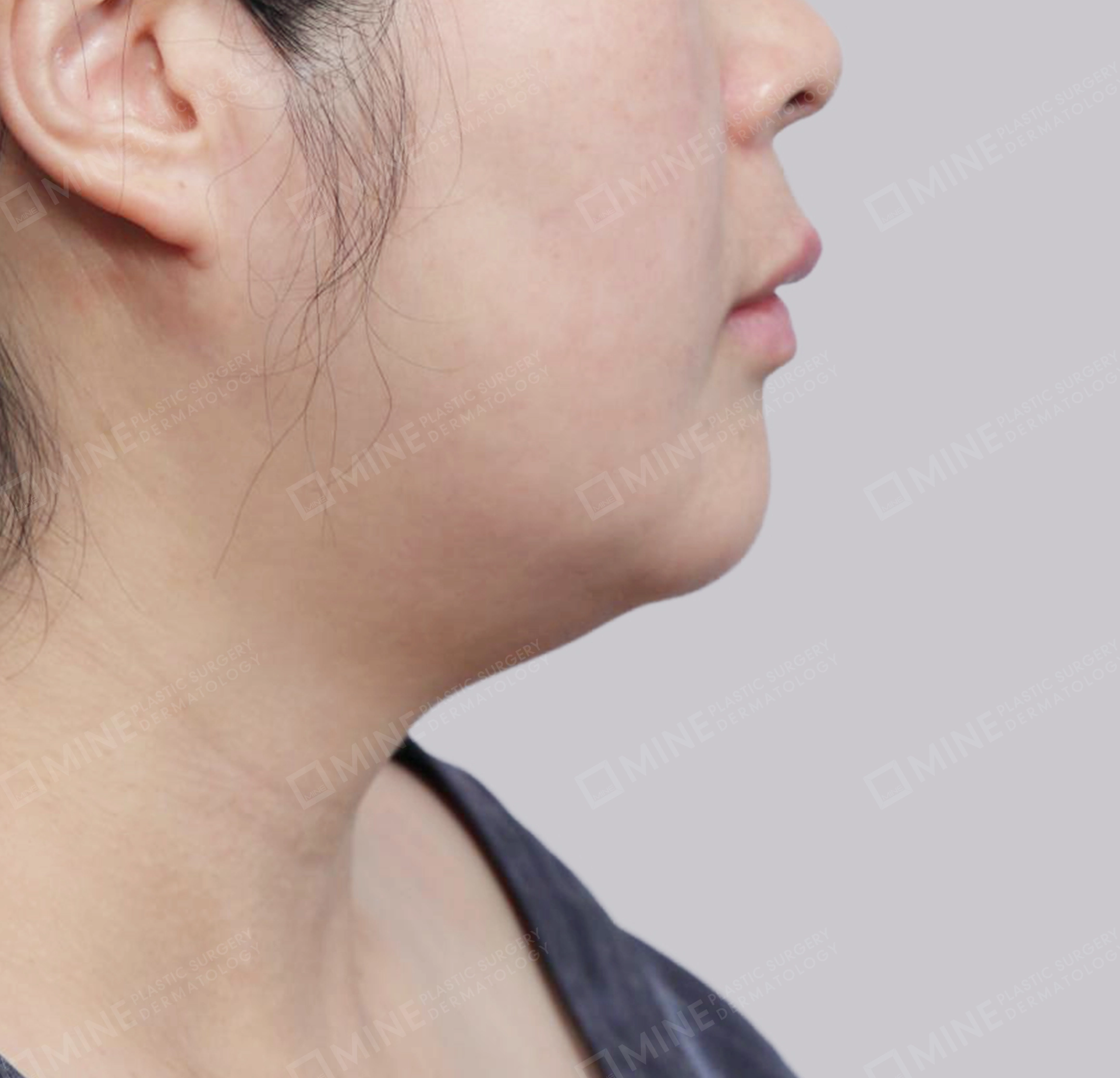 이중턱 근육묶기 + 근육하 지방제거-측면-전