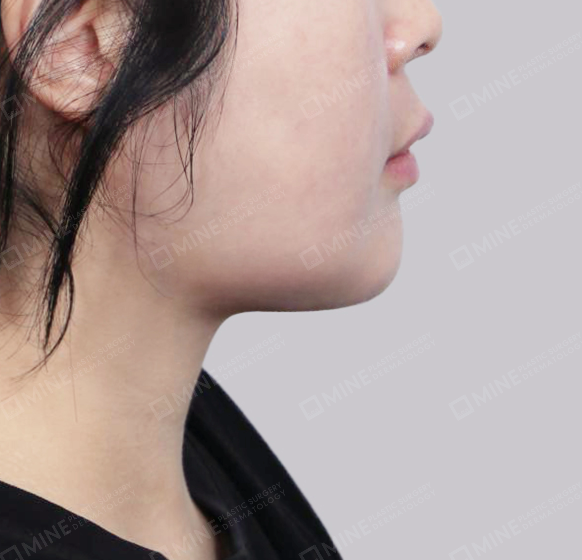 이중턱 근육묶기 + 근육하 지방제거-측면-후