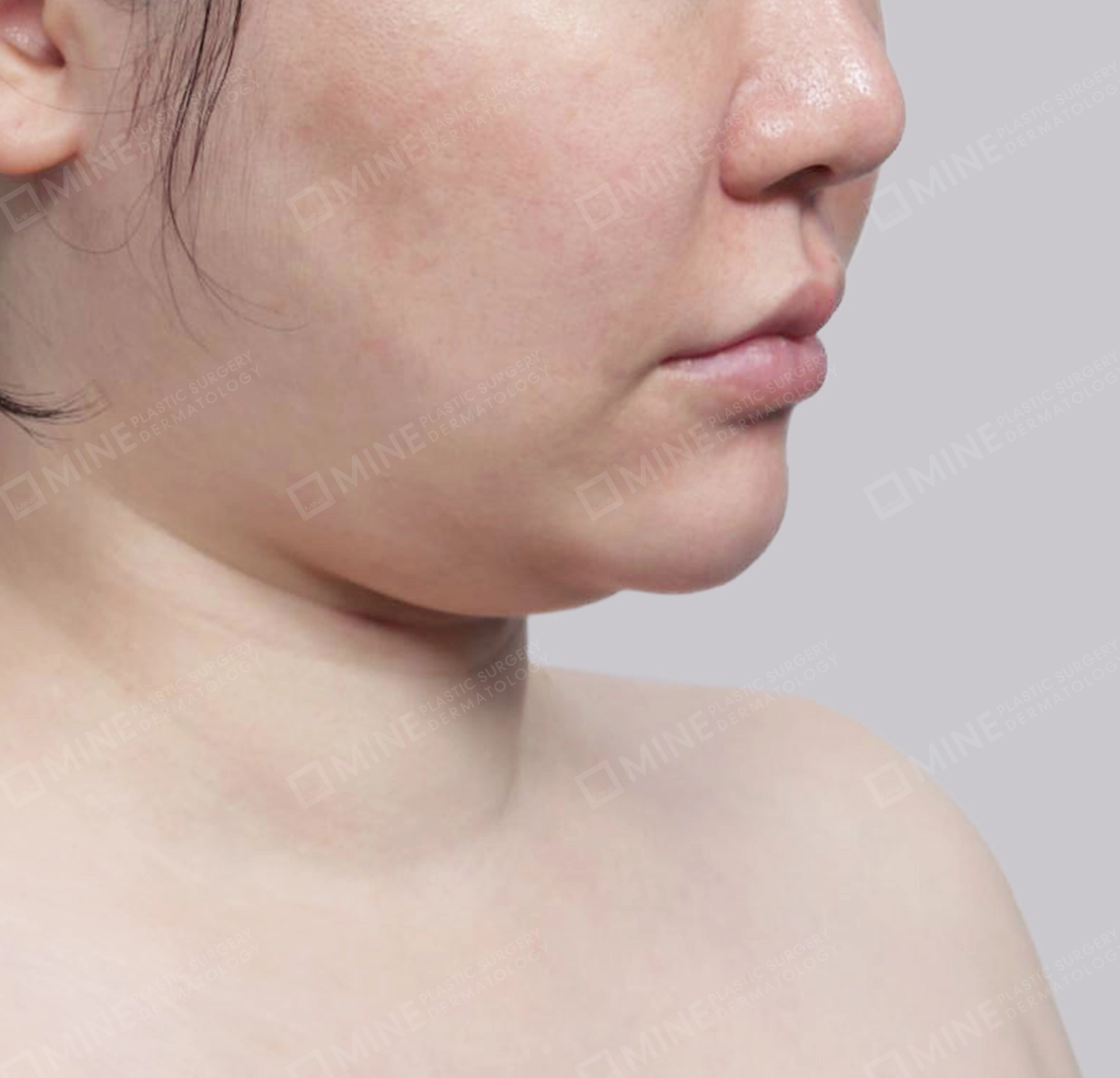 이중턱 근육묶기 + 근육하 지방제거-전후-전