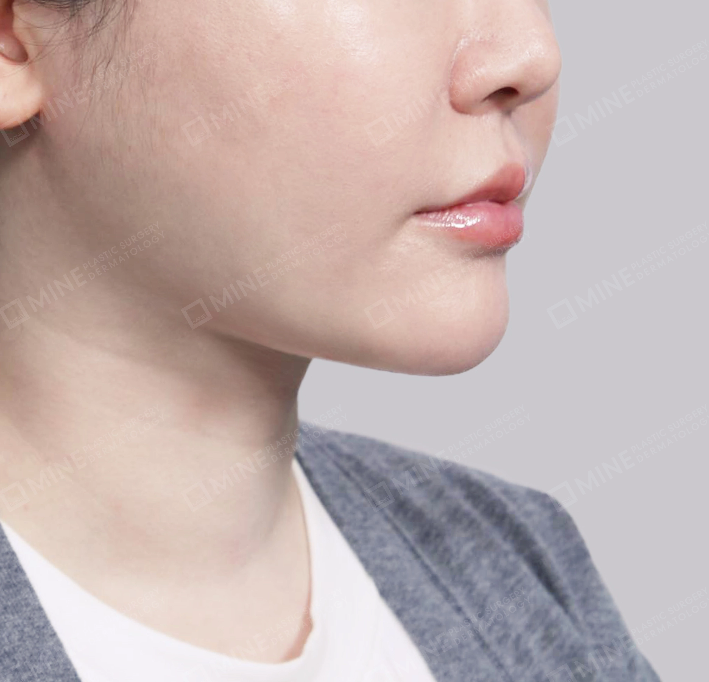 이중턱 근육묶기 + 근육하 지방제거-전후-후