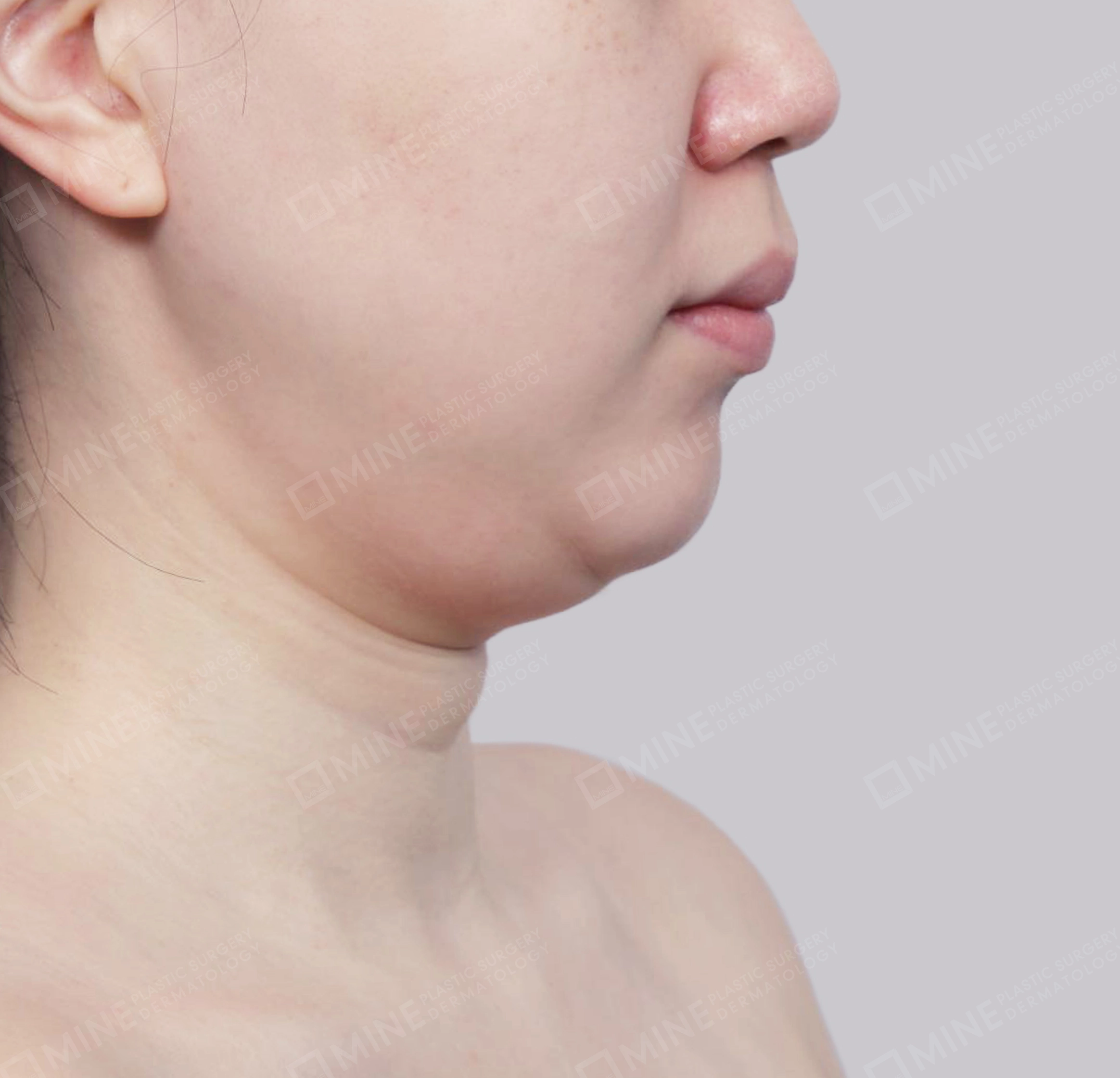 이중턱 근육묶기 + 근육하 지방제거-측면-전