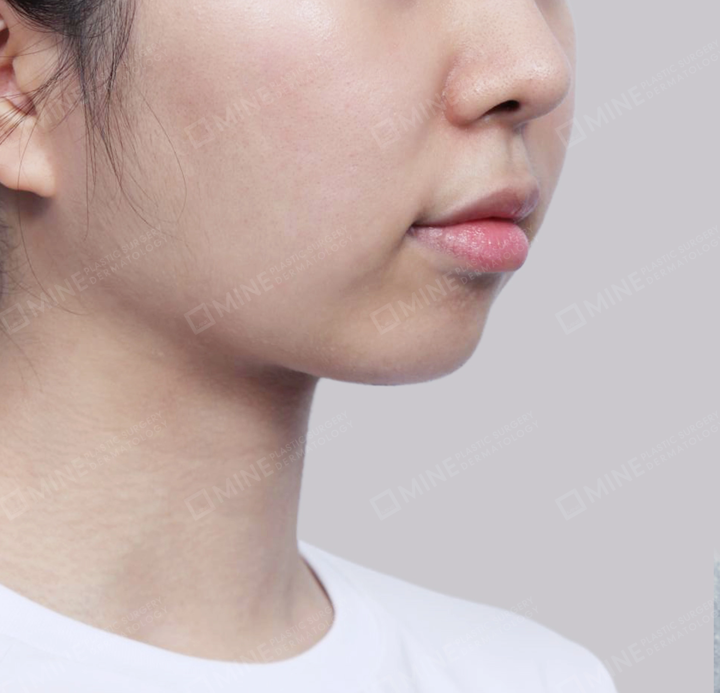 이중턱 근육묶기 + 근육하 지방제거-전후-후