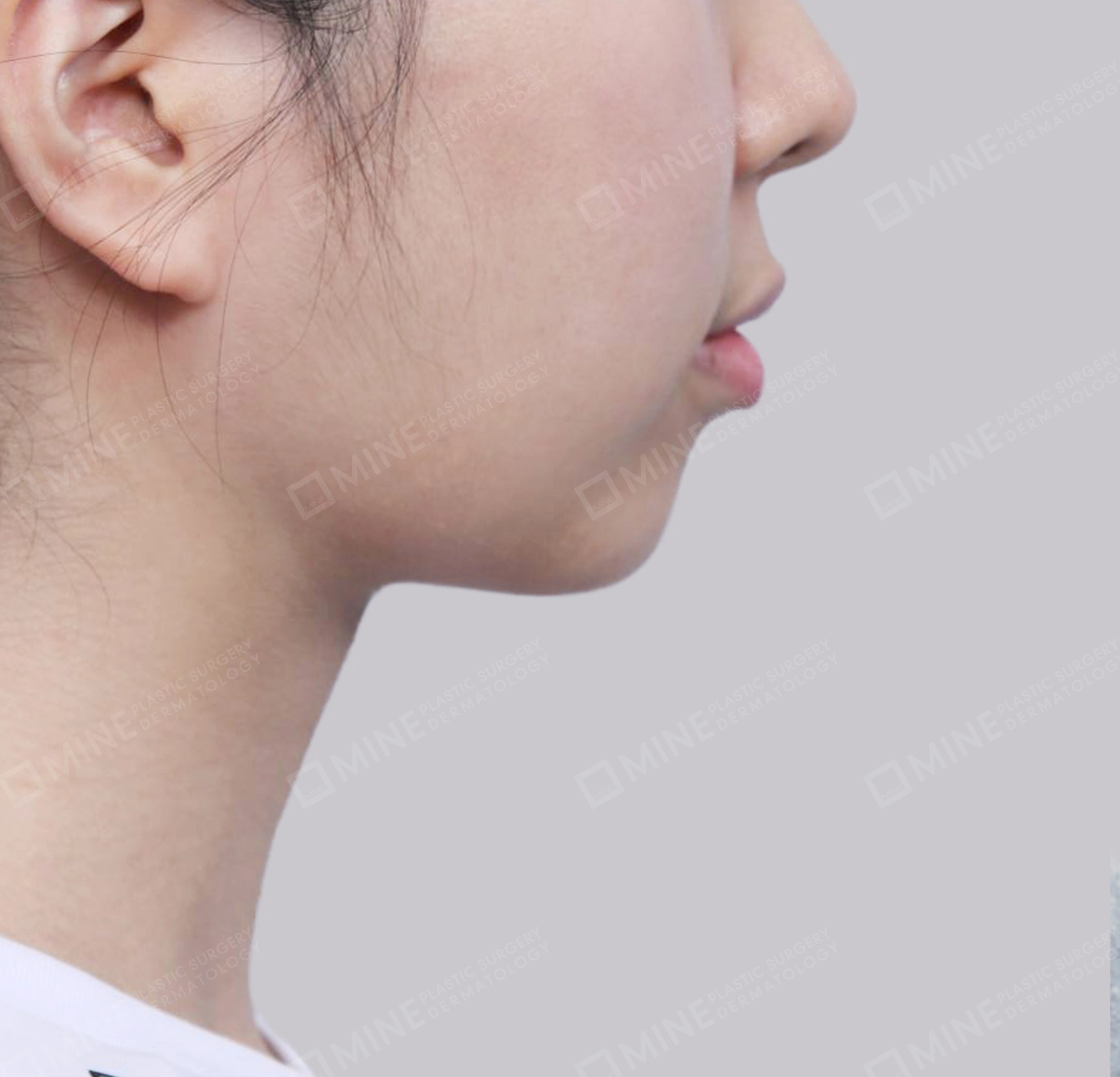 이중턱 근육묶기 + 근육하 지방제거-측면-후