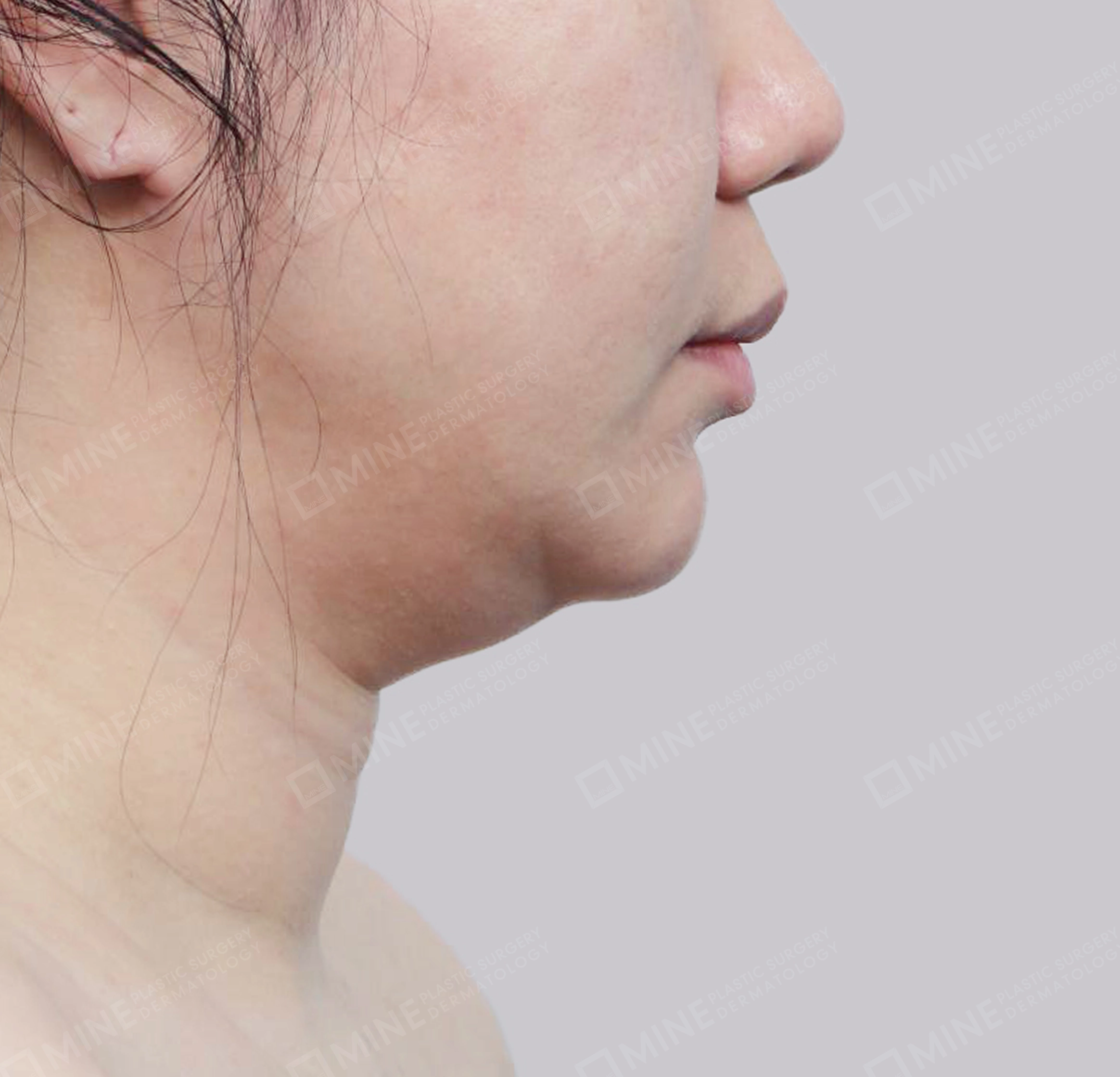 이중턱 근육묶기 + 근육하 지방제거-측면-전